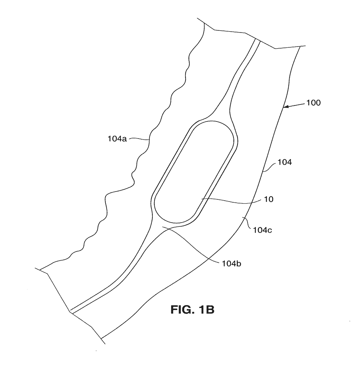 Submucosal gastric implant device and method