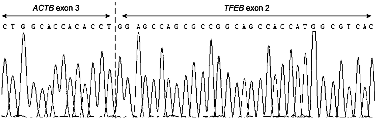 Novel translocation companion of TFEB as well as detection primer and application thereof