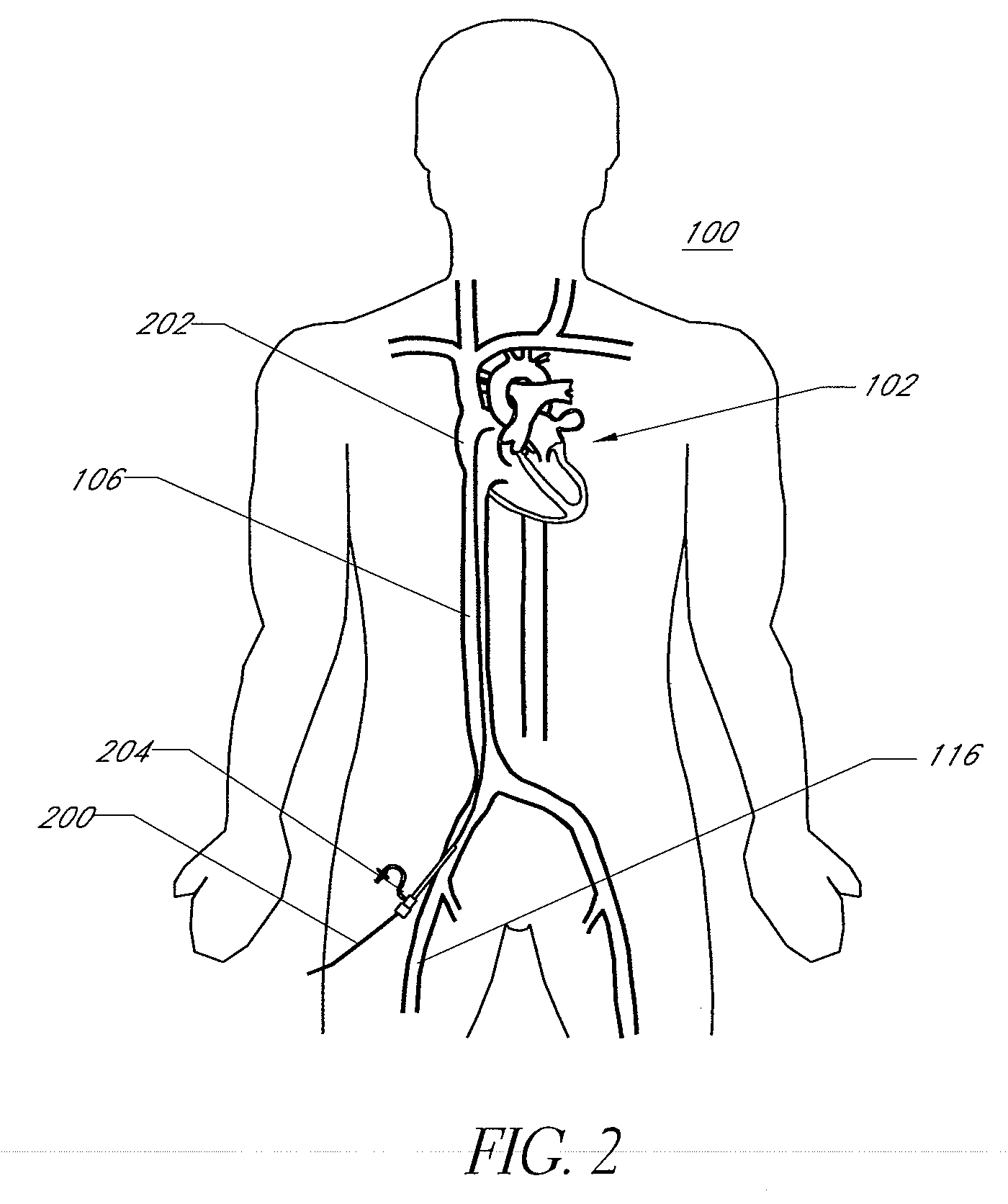 Expandable trans-septal sheath