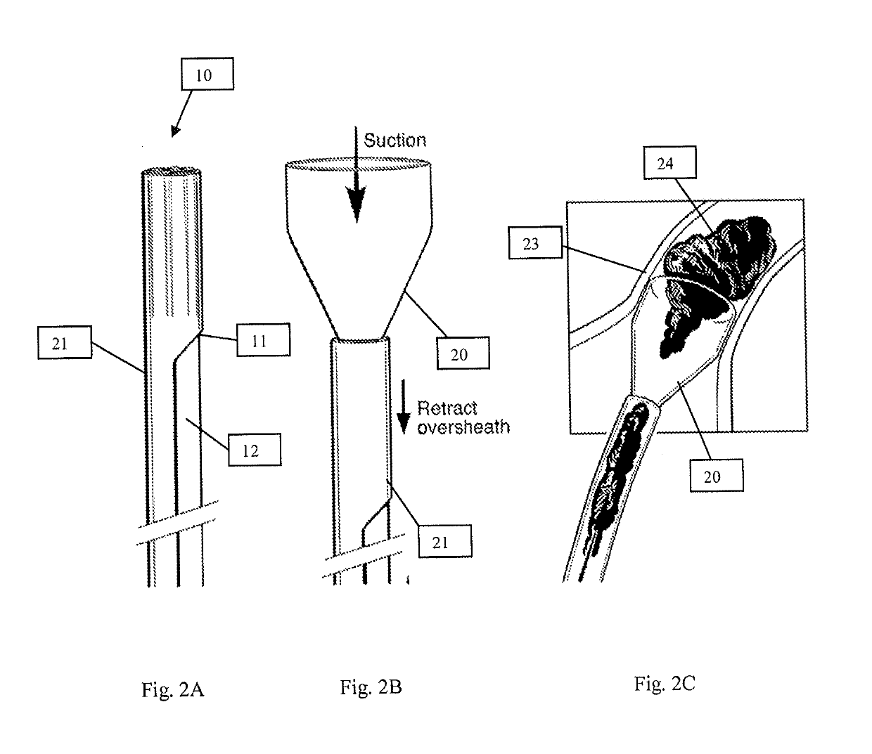 System and Methods for Removing Undesirable Material within a Circulatory System Utilizing during a Surgical Procedure