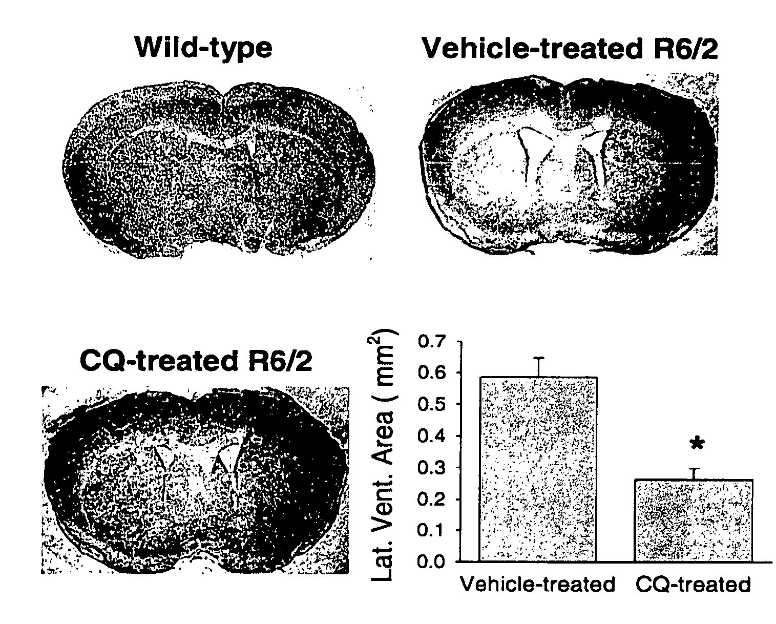 8-hydroxyquinoline compounds for treating a polyglutamine (polyQ)-expansion disease