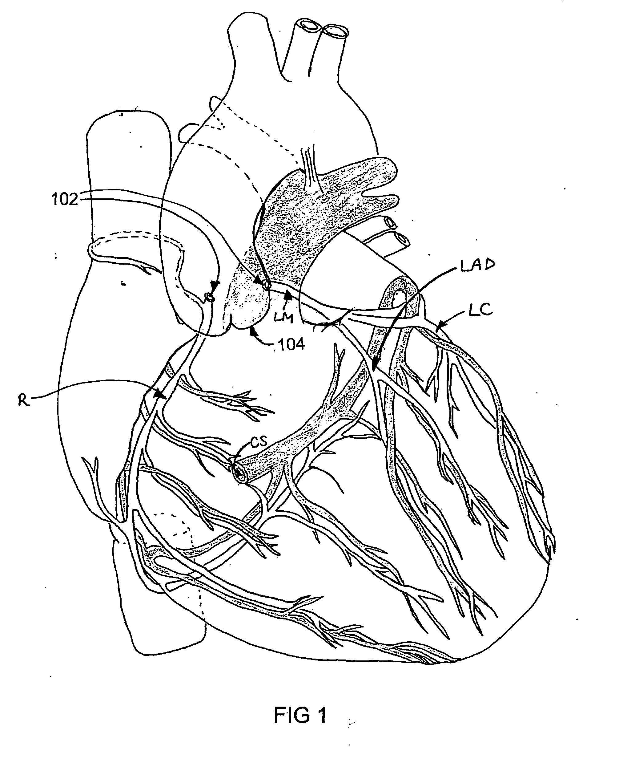 Isolating cardiac circulation