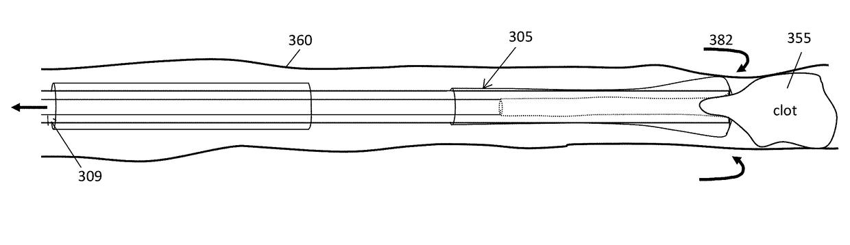 Pre-loaded inverting tractor thrombectomy apparatuses and methods