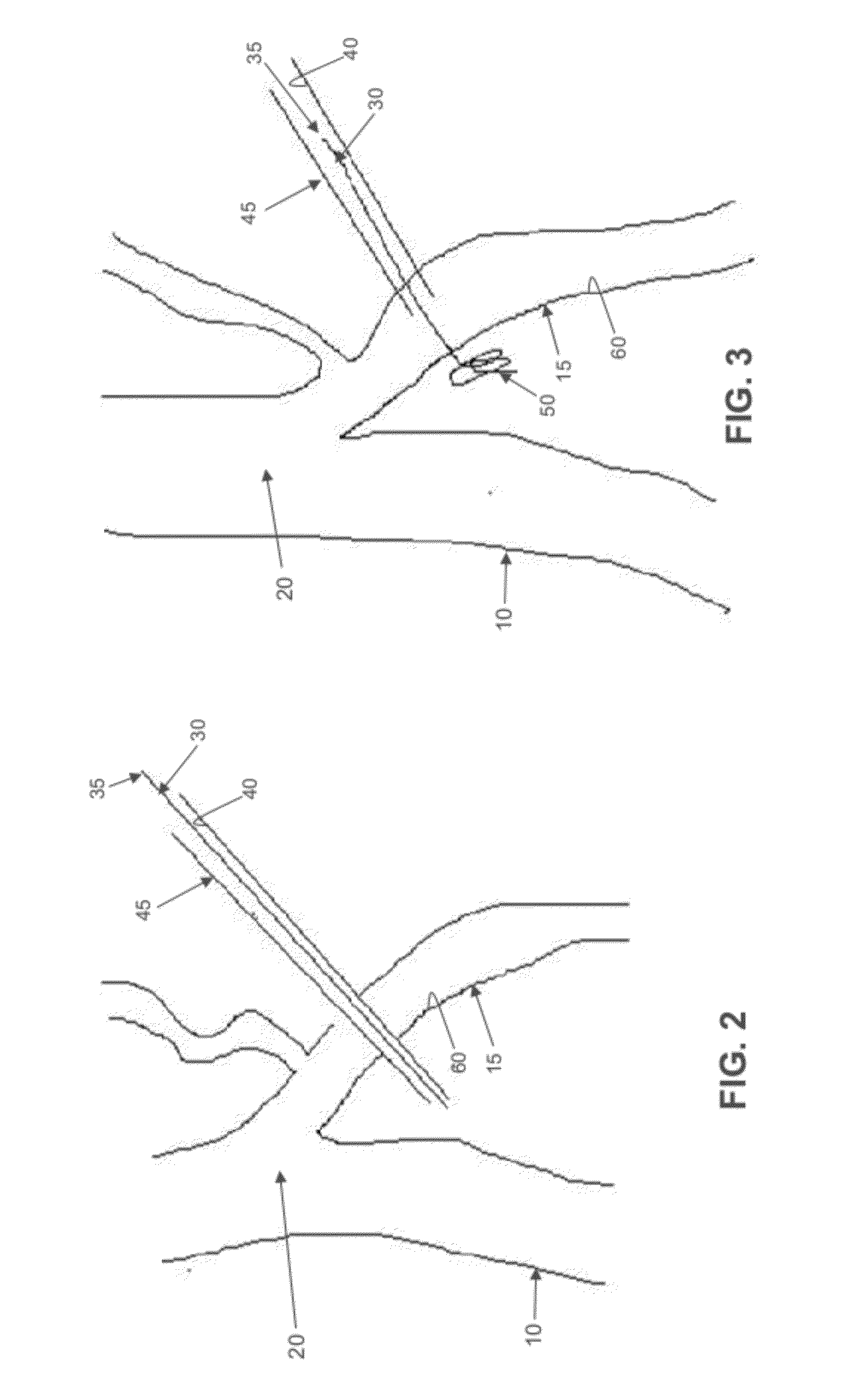 Method and apparatus for treating varicose veins