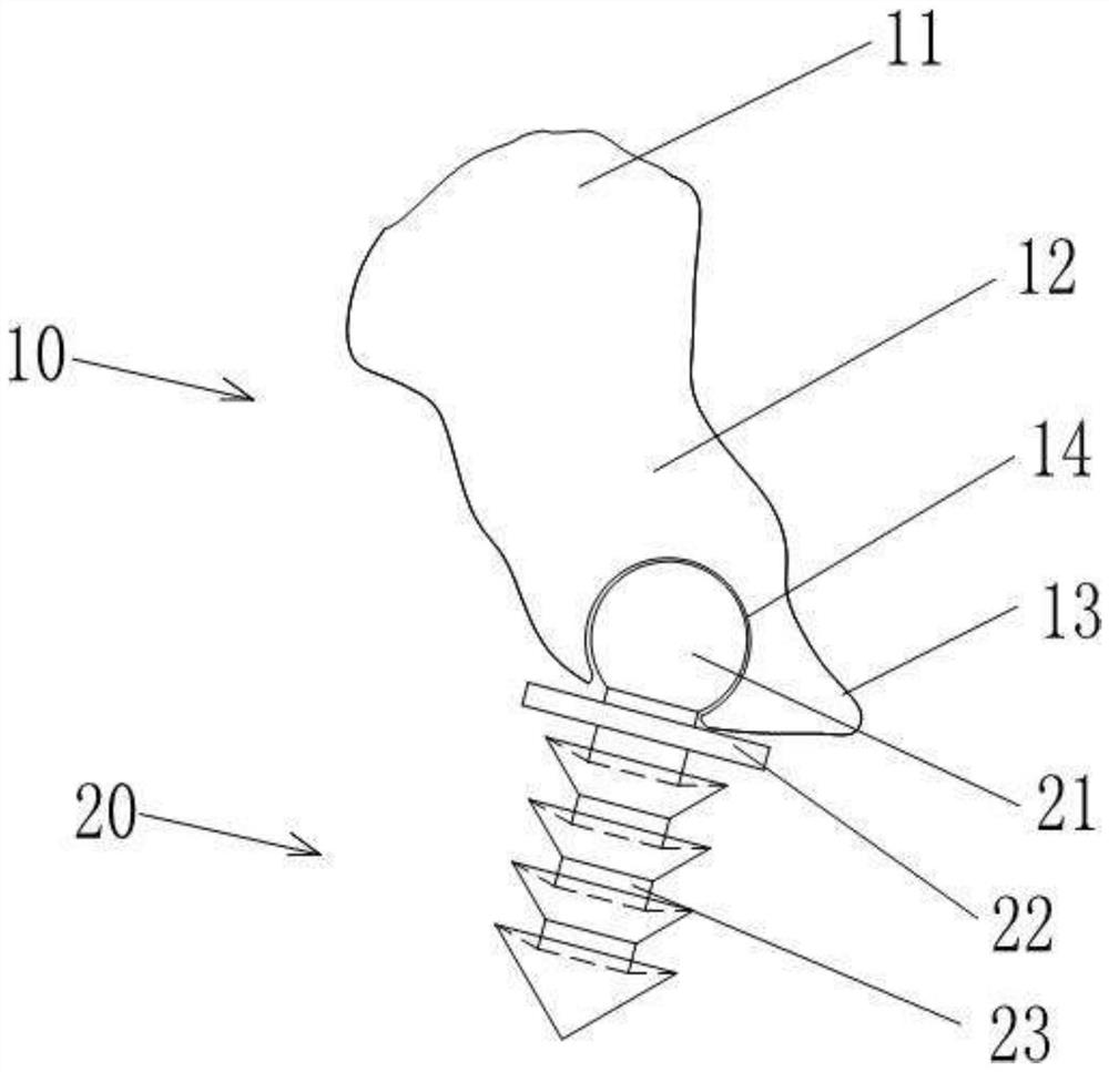 Driving inverted tooth type ball socket joint artificial navicular bone