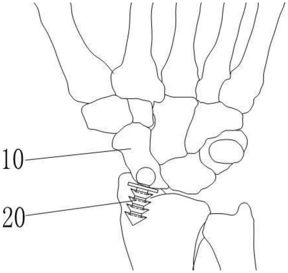 Driving inverted tooth type ball socket joint artificial navicular bone