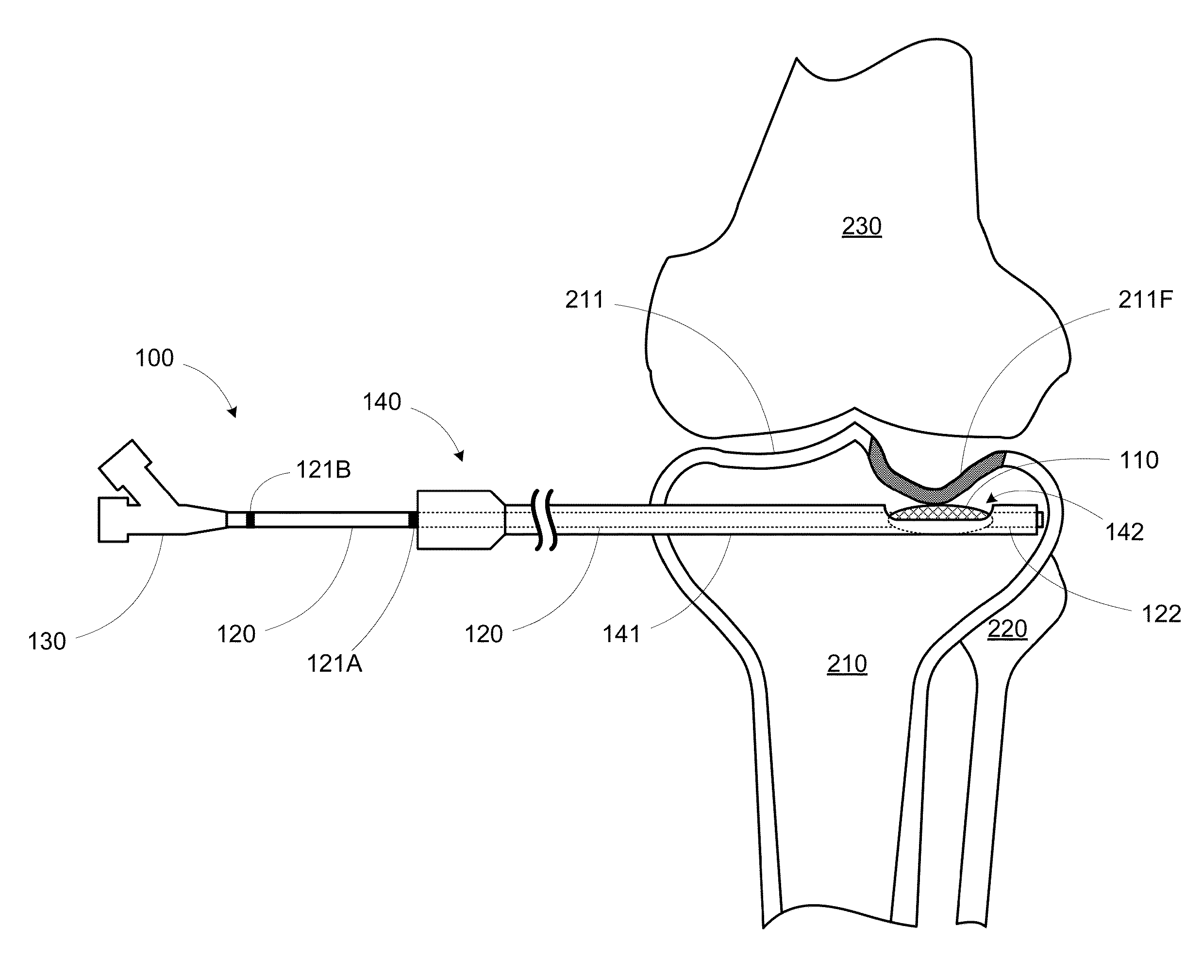 Combination directional and non-directional bone tamp