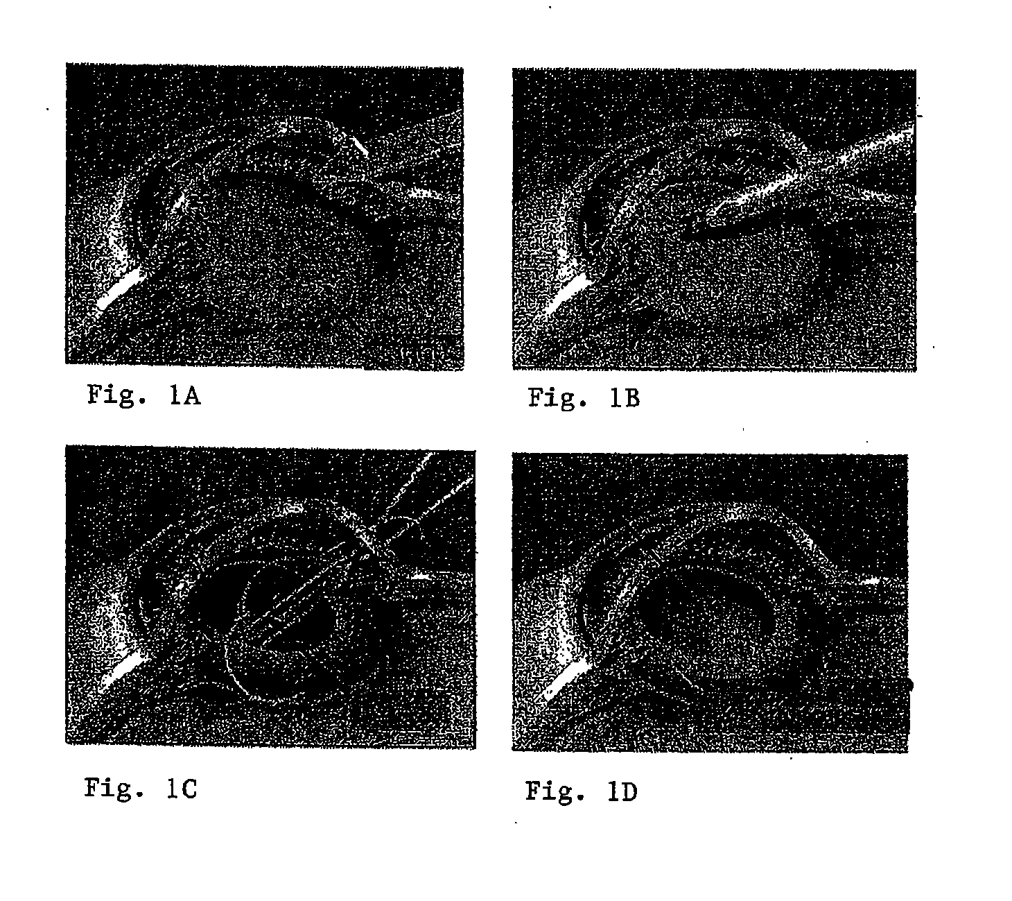 Methods and Devices for Preventing or Delaying Posterior Capsule Opacification