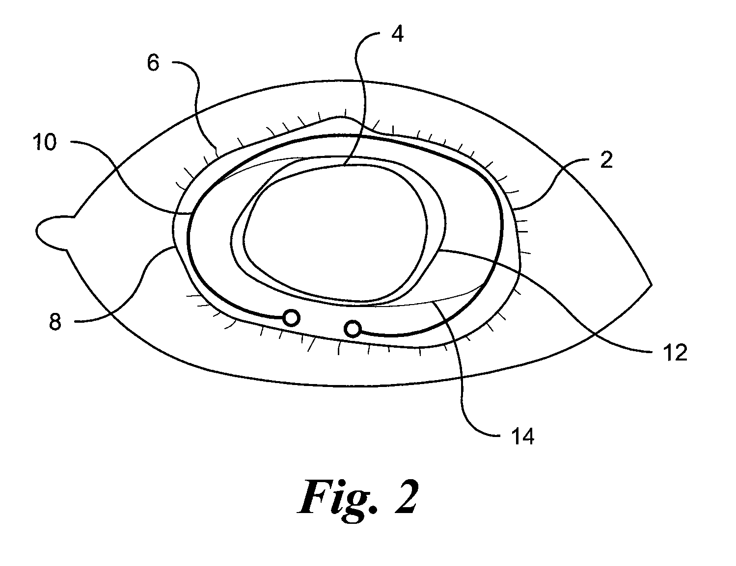 Methods and Devices for Preventing or Delaying Posterior Capsule Opacification