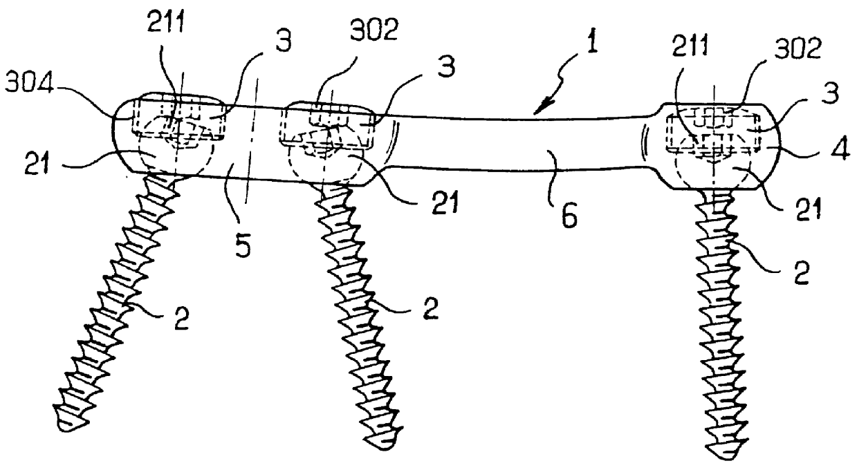 Bone fixing device, in particular for fixing to the sacrum during osteosynthesis of the backbone