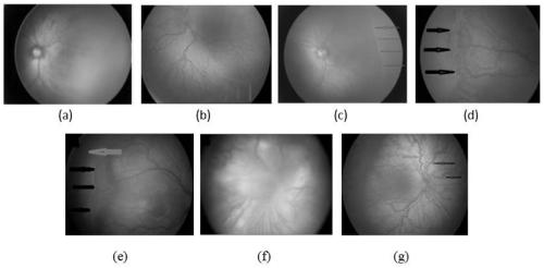 Premature infant retinal image classification method and device based on attention mechanism