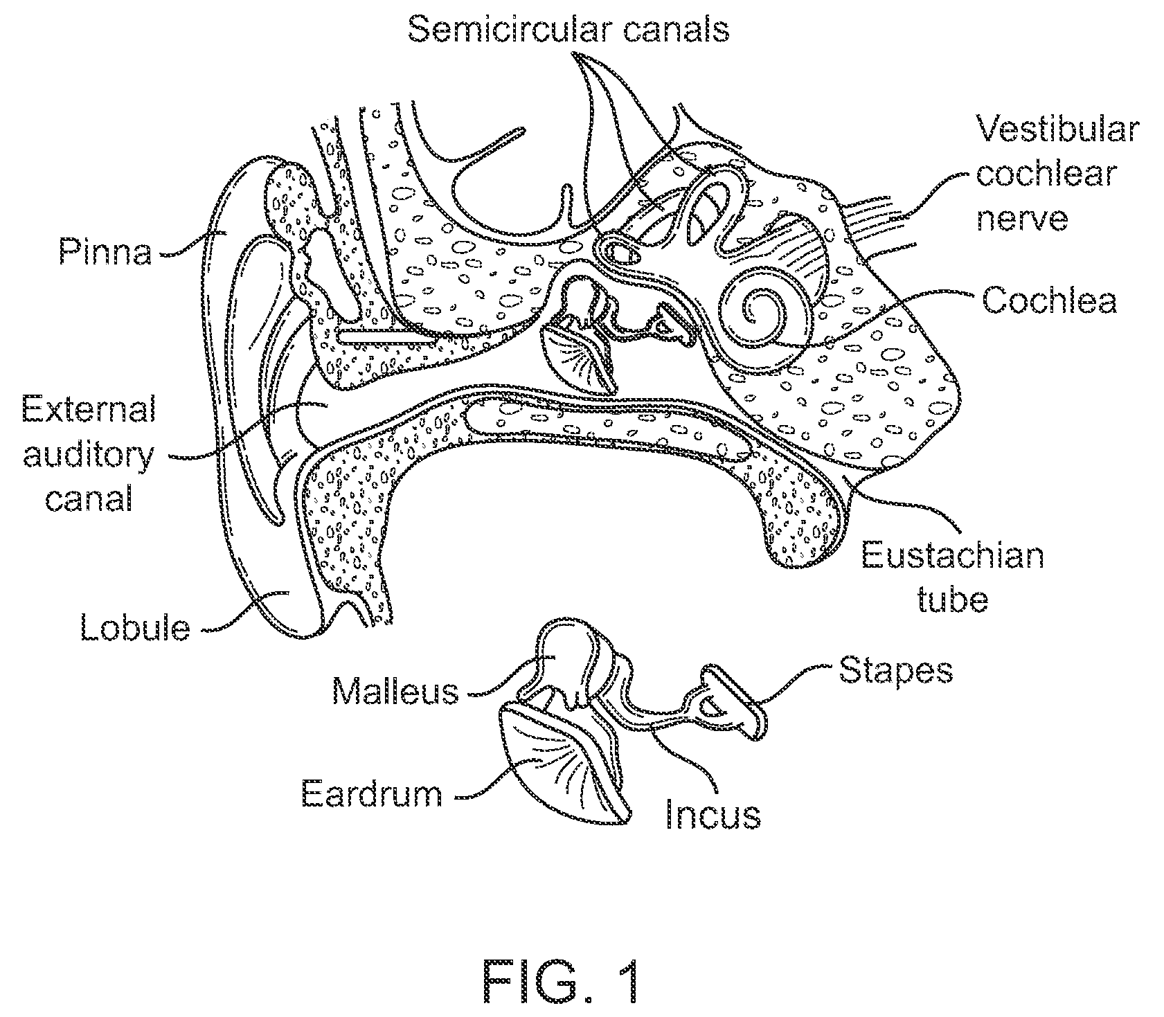 Systems and methods for implantable leadless cochlear stimulation
