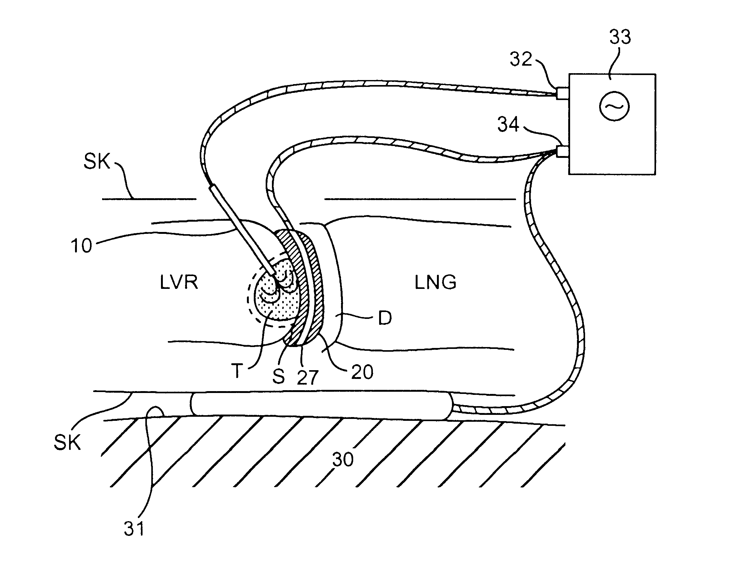 Apparatus and method for shielding tissue during tumor ablation