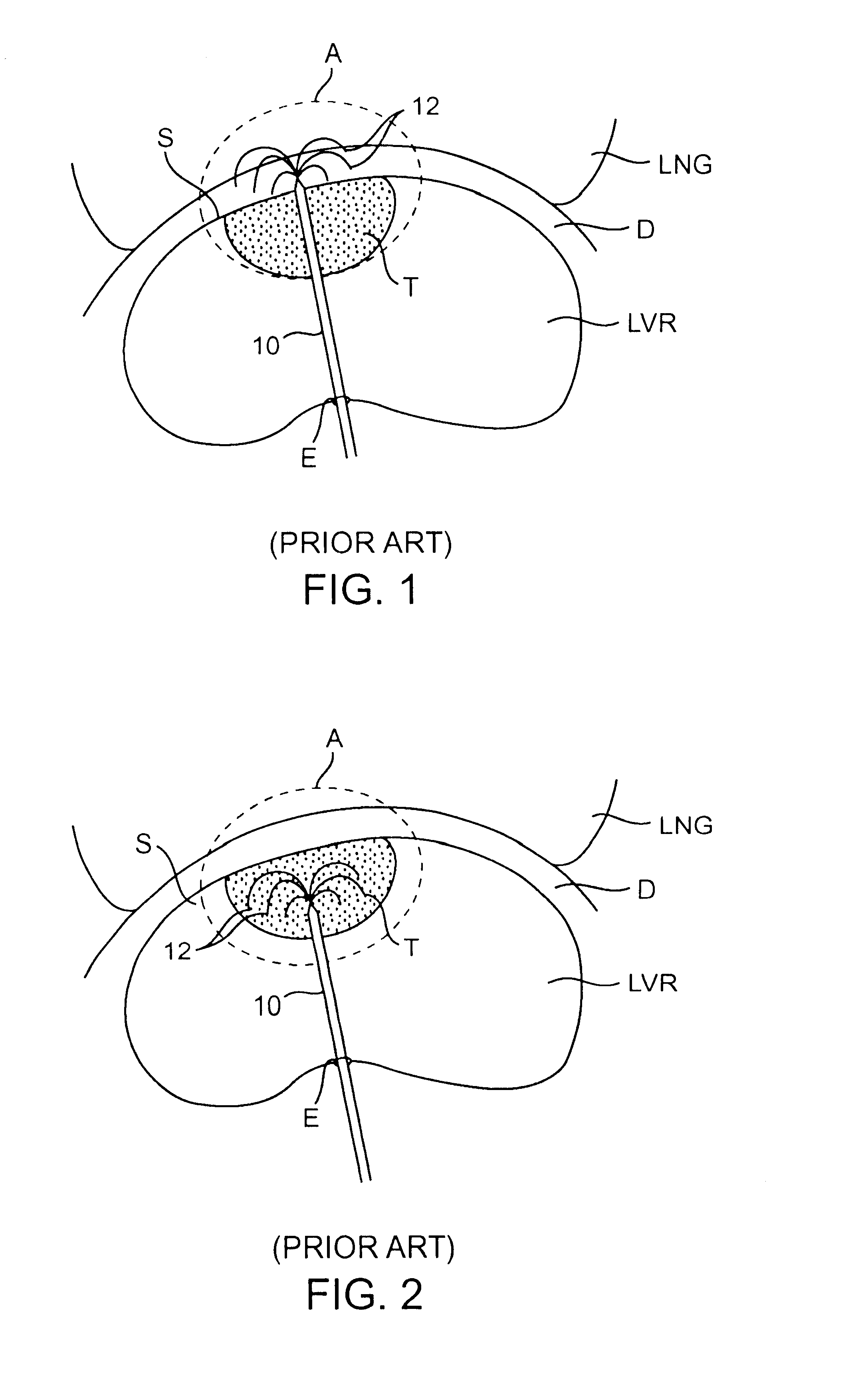 Apparatus and method for shielding tissue during tumor ablation