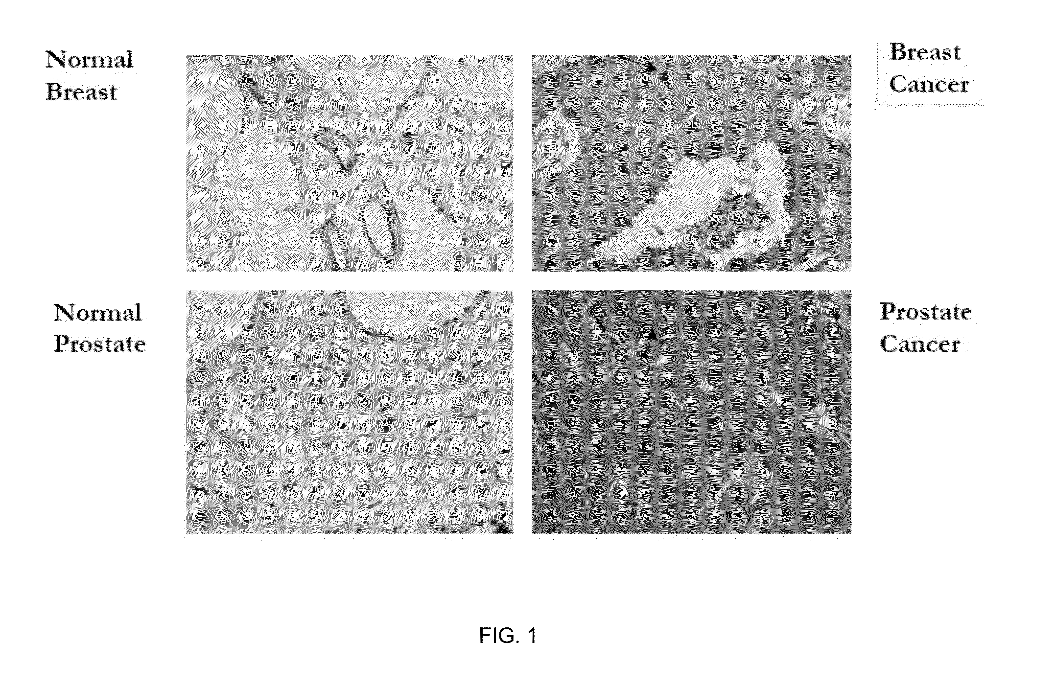 Methods and Compositions for the Diagnosis and Treatment of Epithelial Cancers