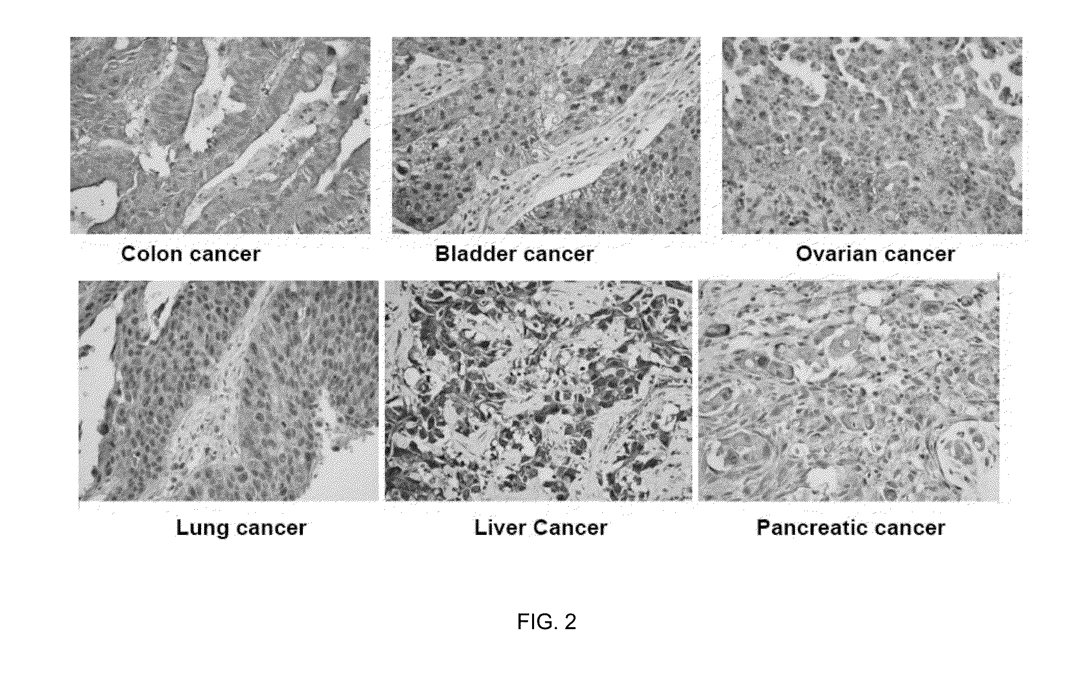 Methods and Compositions for the Diagnosis and Treatment of Epithelial Cancers