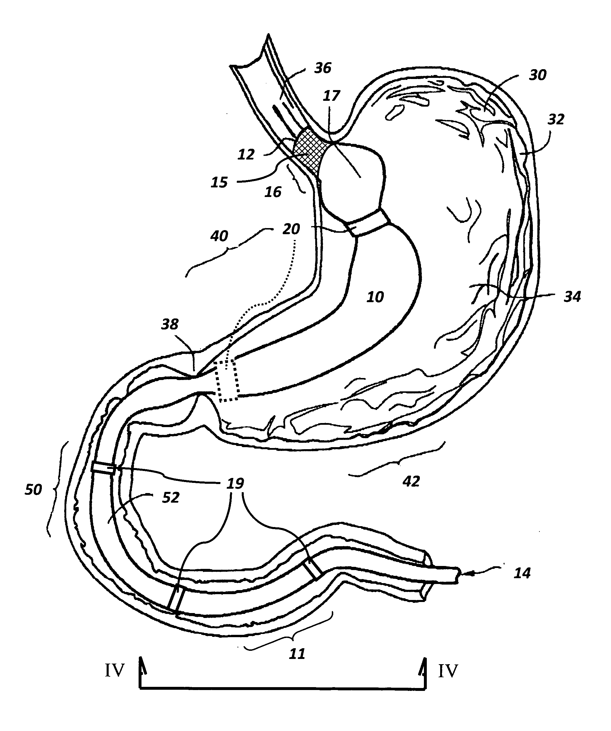 Devices and methods for endolumenal therapy