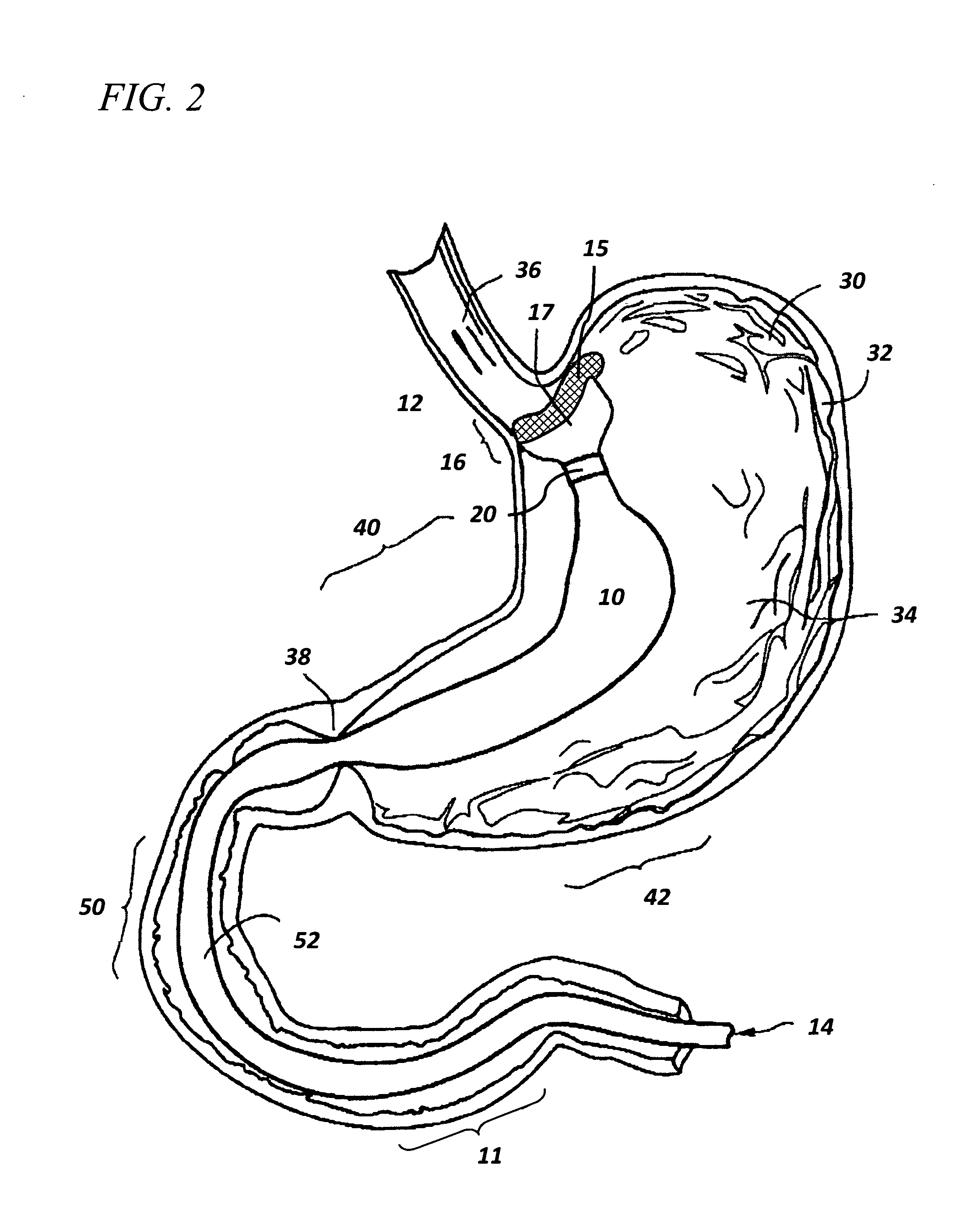Devices and methods for endolumenal therapy
