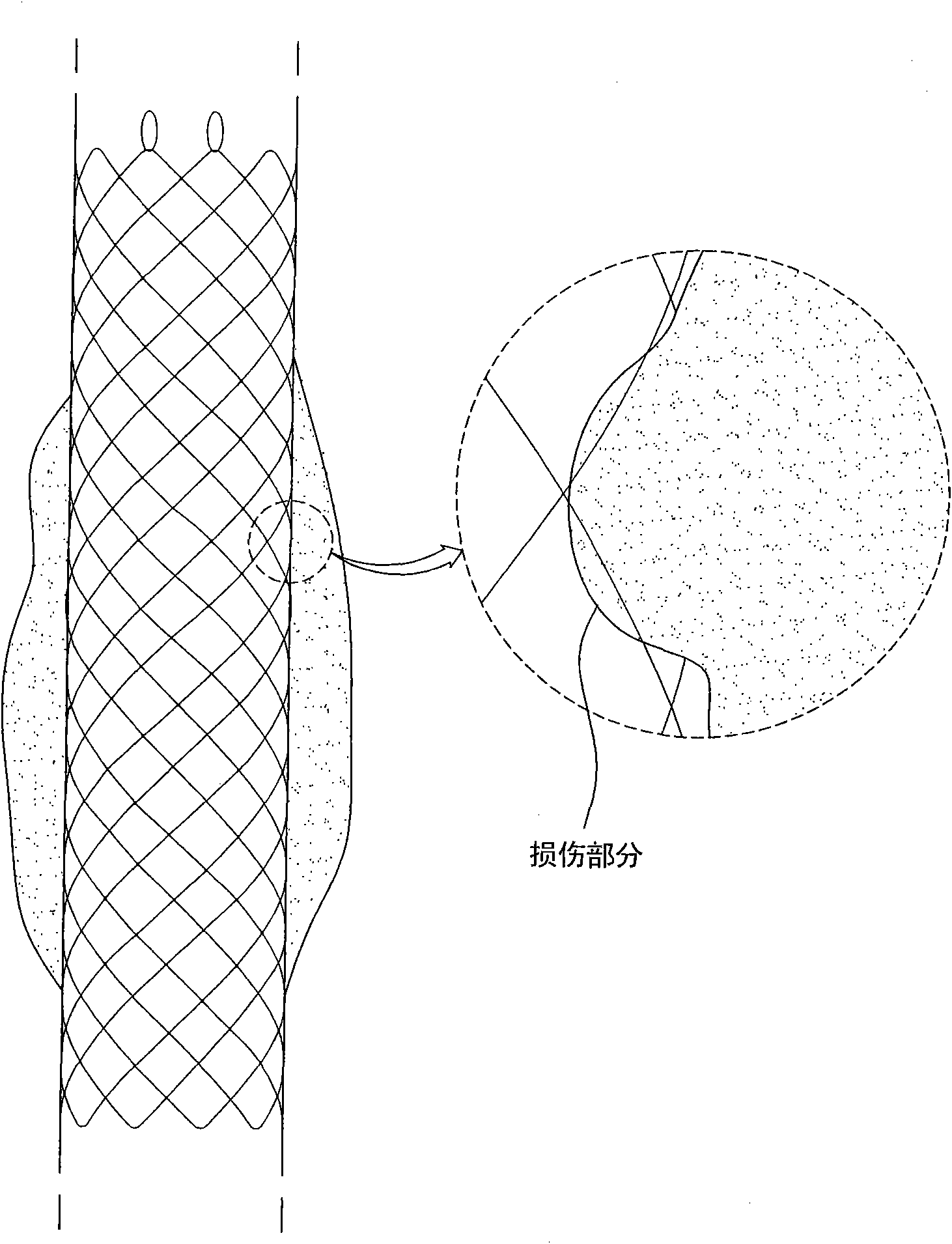 Drawstring for removal of stent