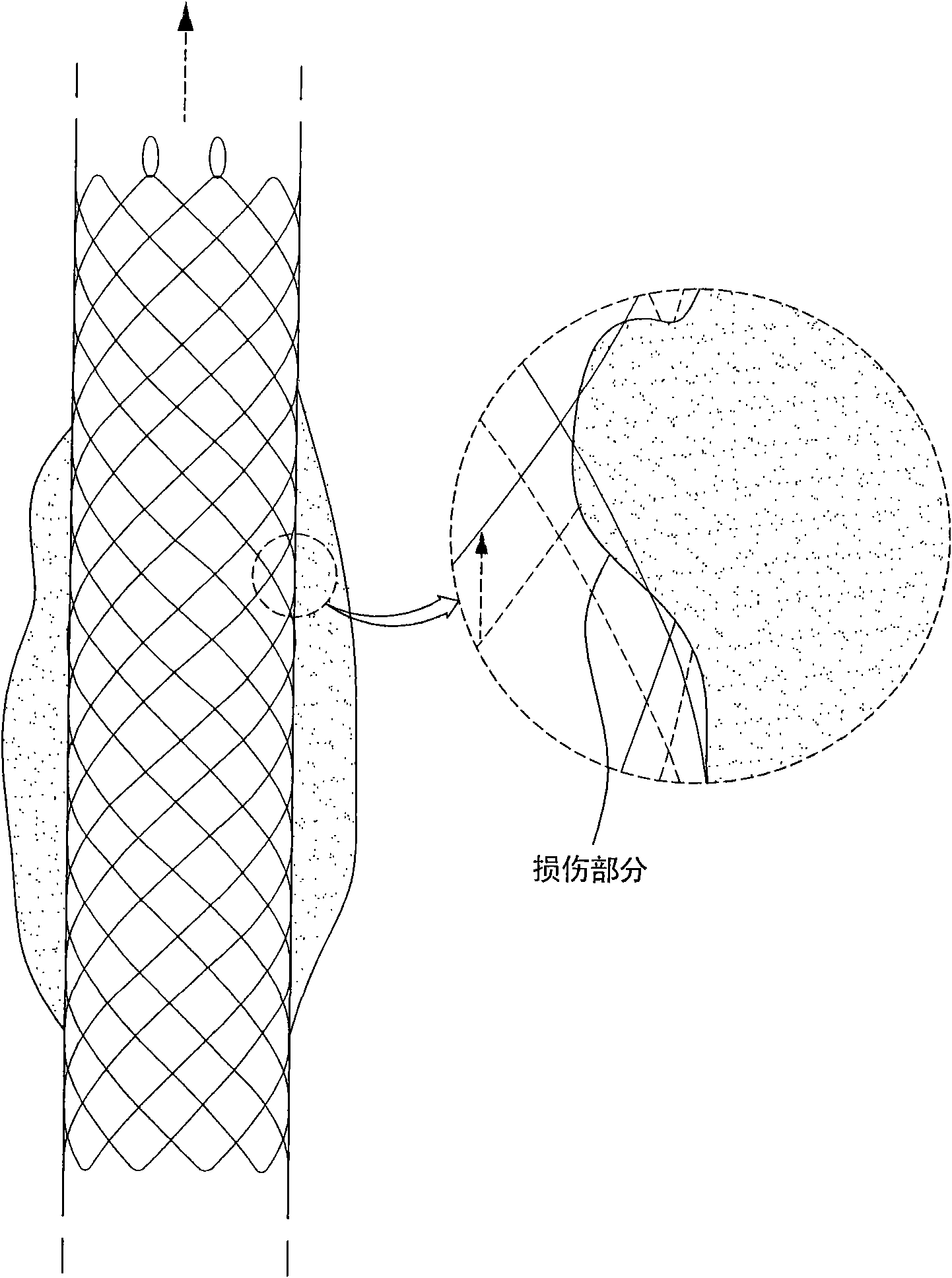 Drawstring for removal of stent