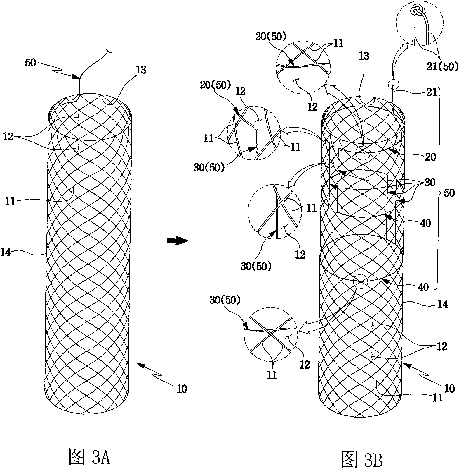 Drawstring for removal of stent