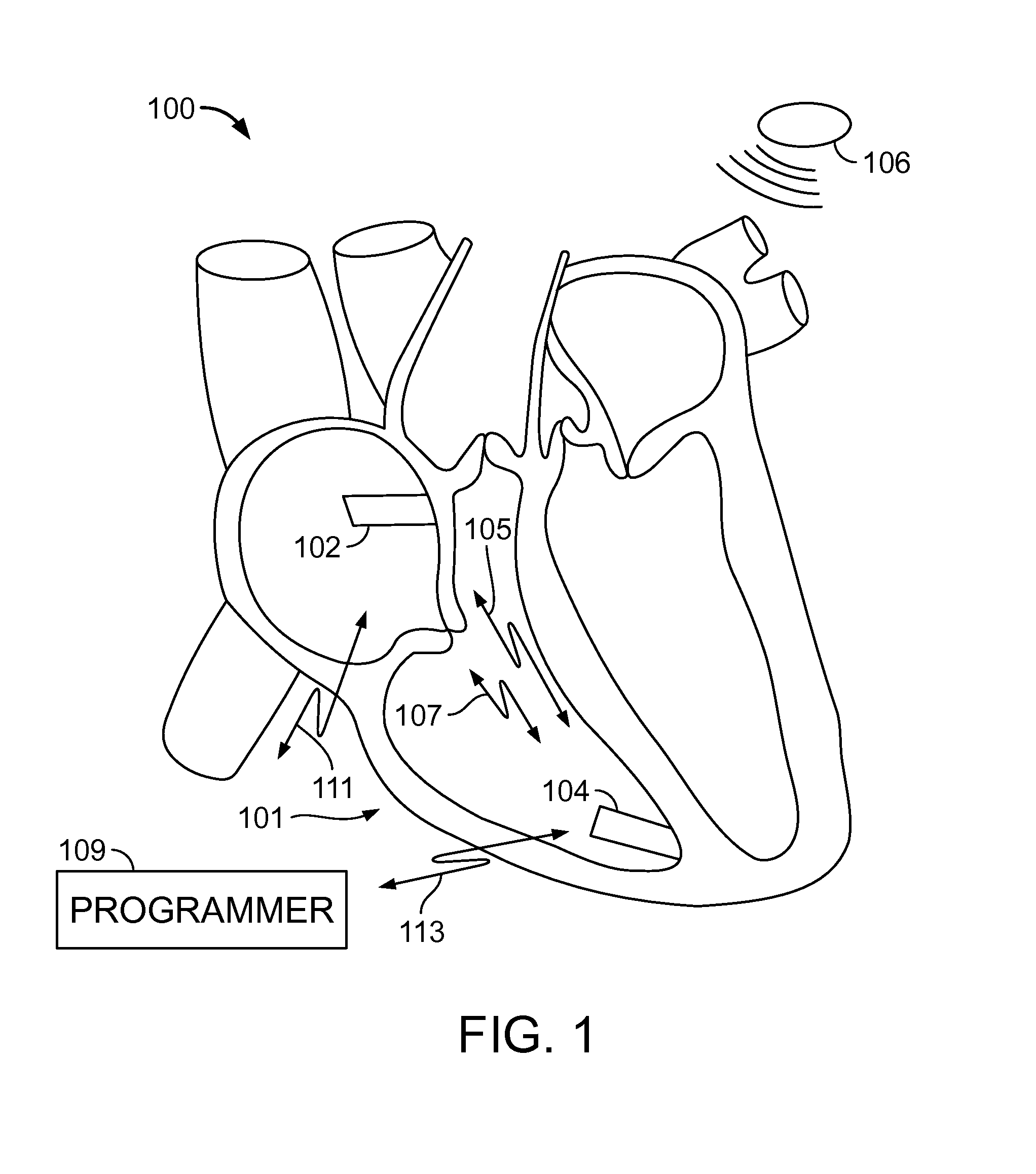 Leadless dual-chamber pacing system and method