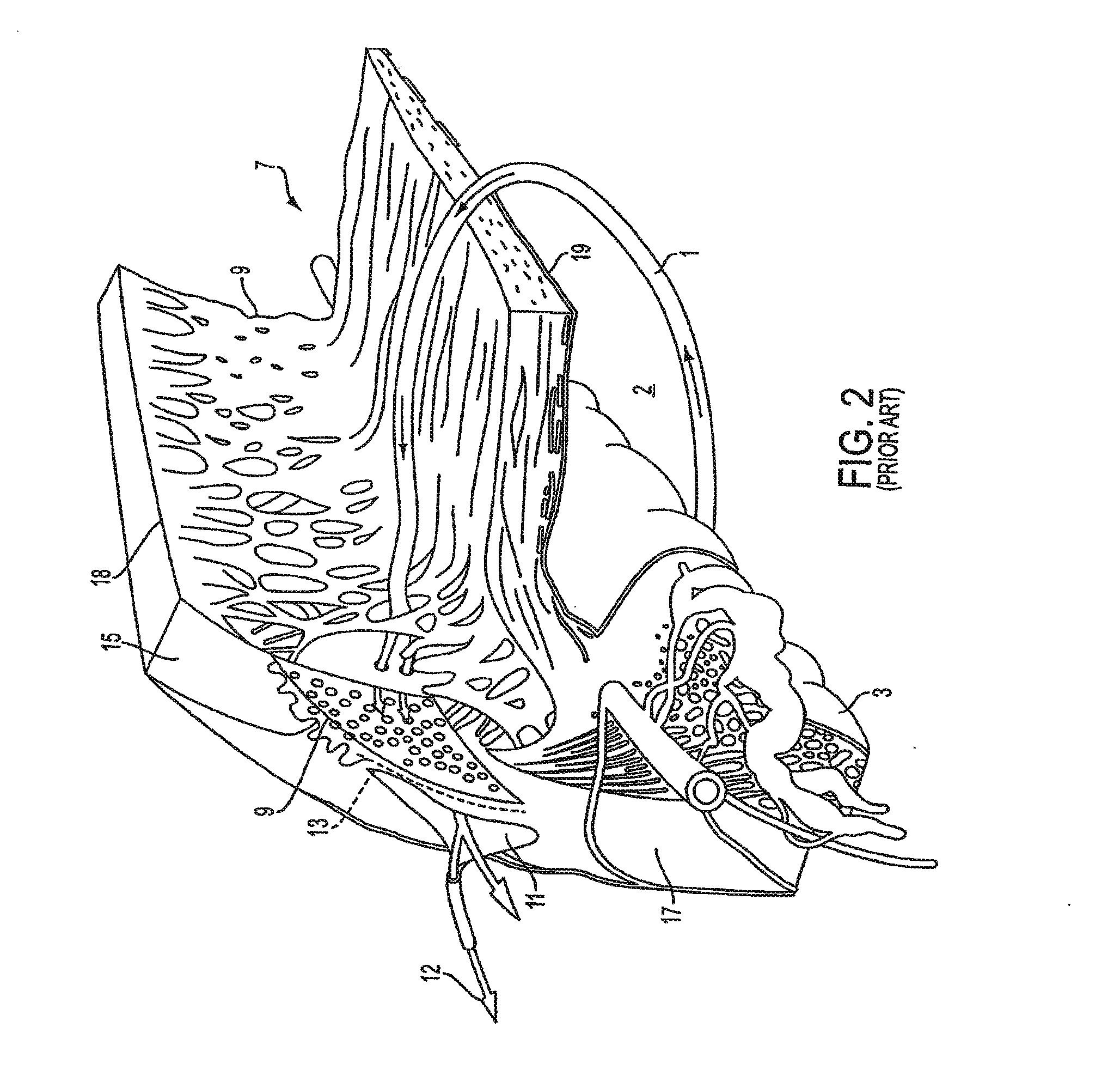 Delivery System and Method of Use for the Eye