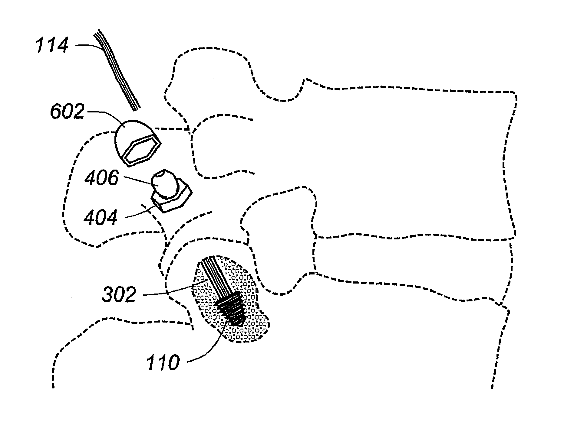 Dynamic/static facet fixation device and method