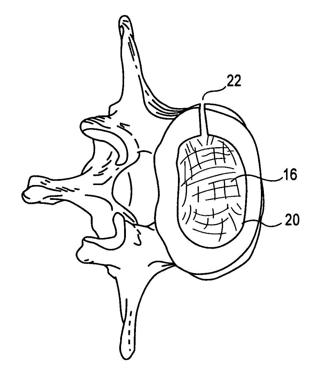 Packed demineralized cancellous tissue forms for disc nucleus augmentation, restoration, or replacement and methods of implantation