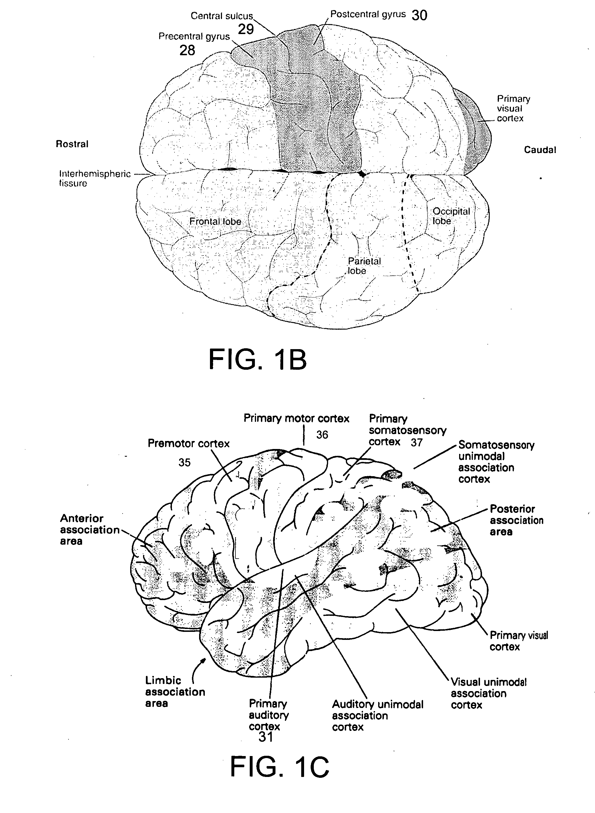 Method and system for cortical stimulation to provide adjunct (ADD-ON) therapy for stroke, tinnitus and other medical disorders using implantable and external components
