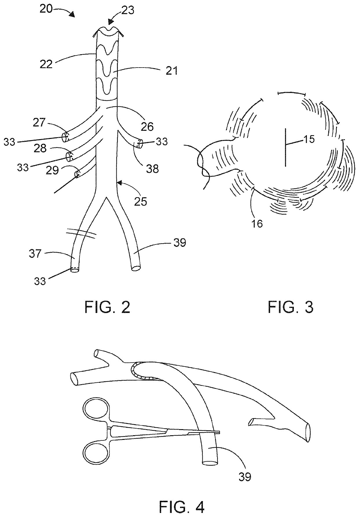 Hybrid prosthesis and delivery system
