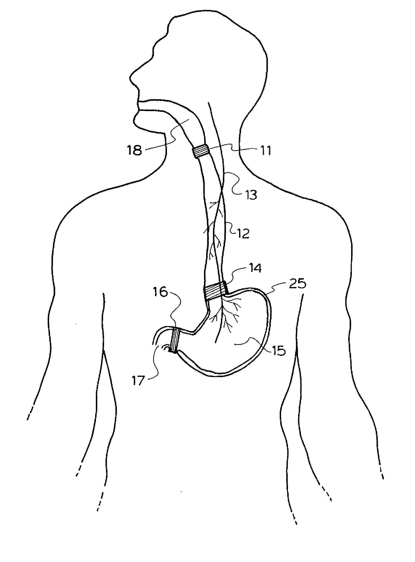 Method and apparatus for treatment of the gastrointestinal tract