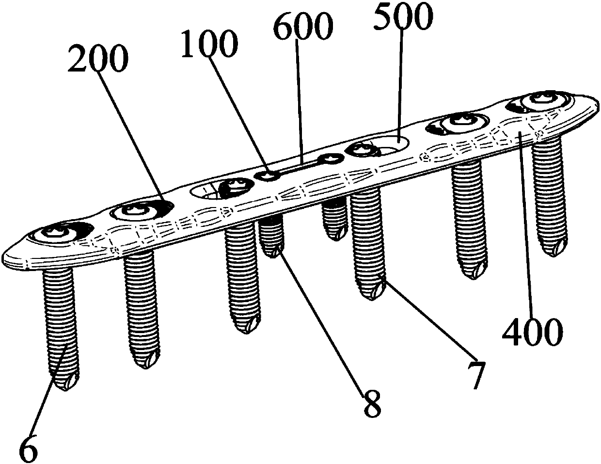Stress pattern pressuring and locking osteosynthesis device