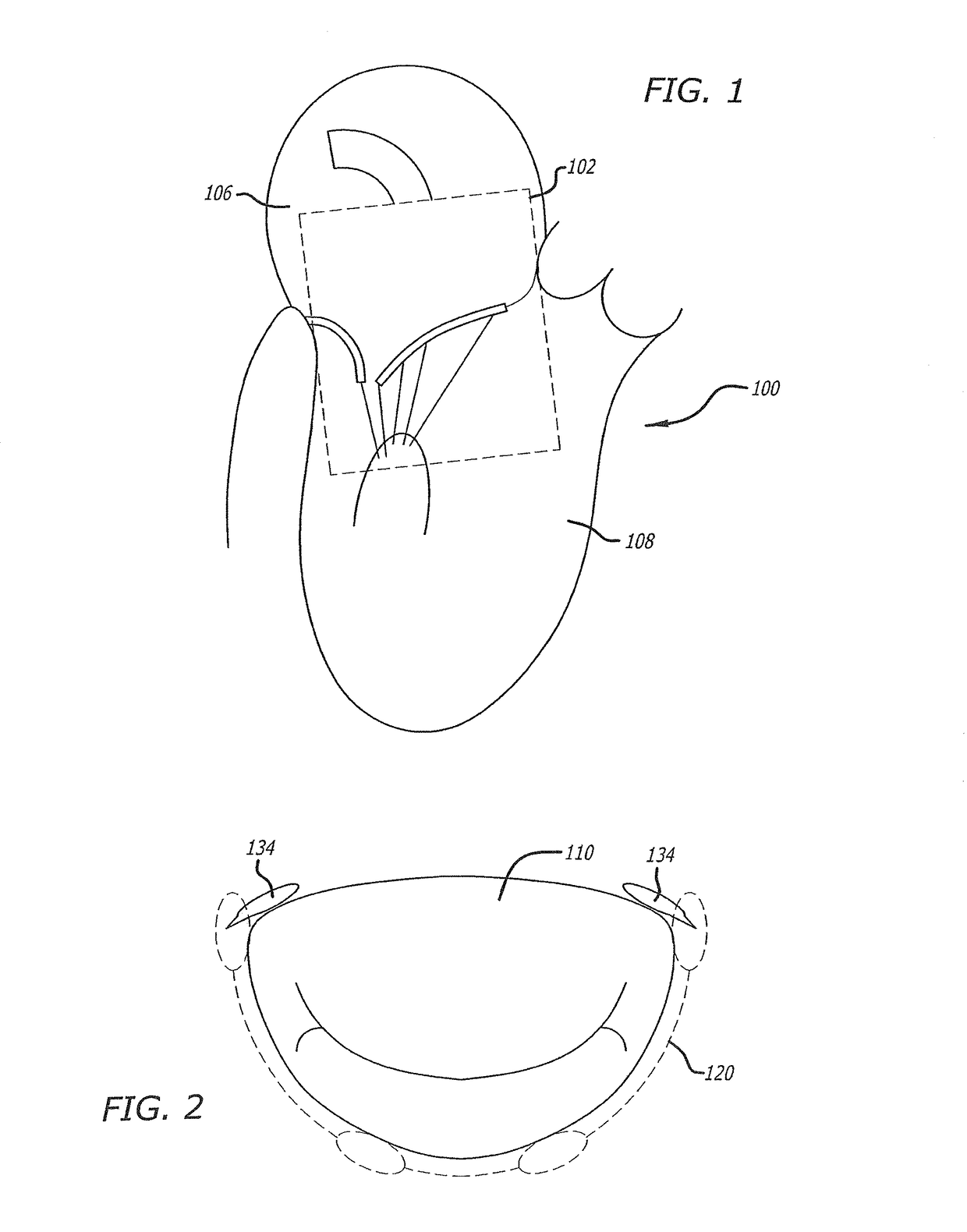Two stage anchor and mitral valve assembly