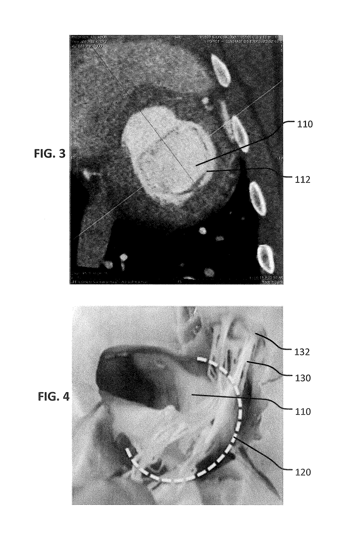 Two stage anchor and mitral valve assembly