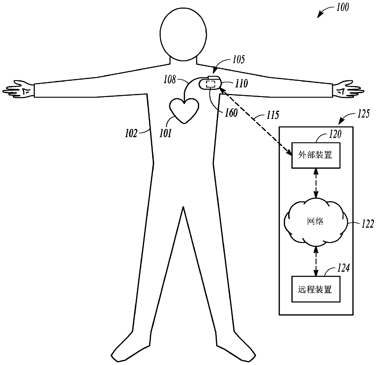 Systems and methods for atrial arrhythmia detection