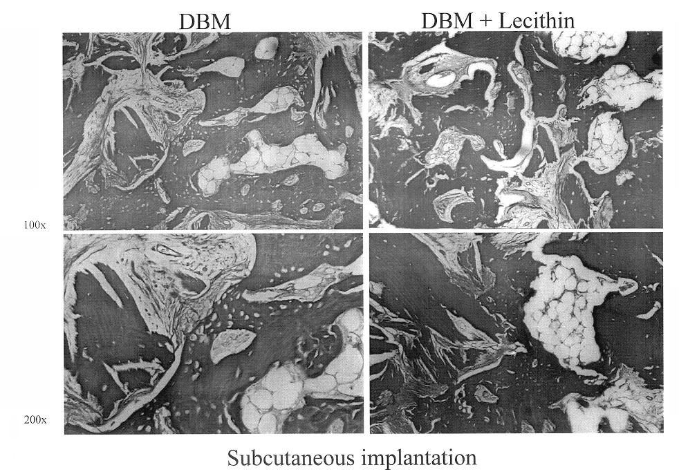 Bone graft material incorporating demineralized bone matrix and lipids