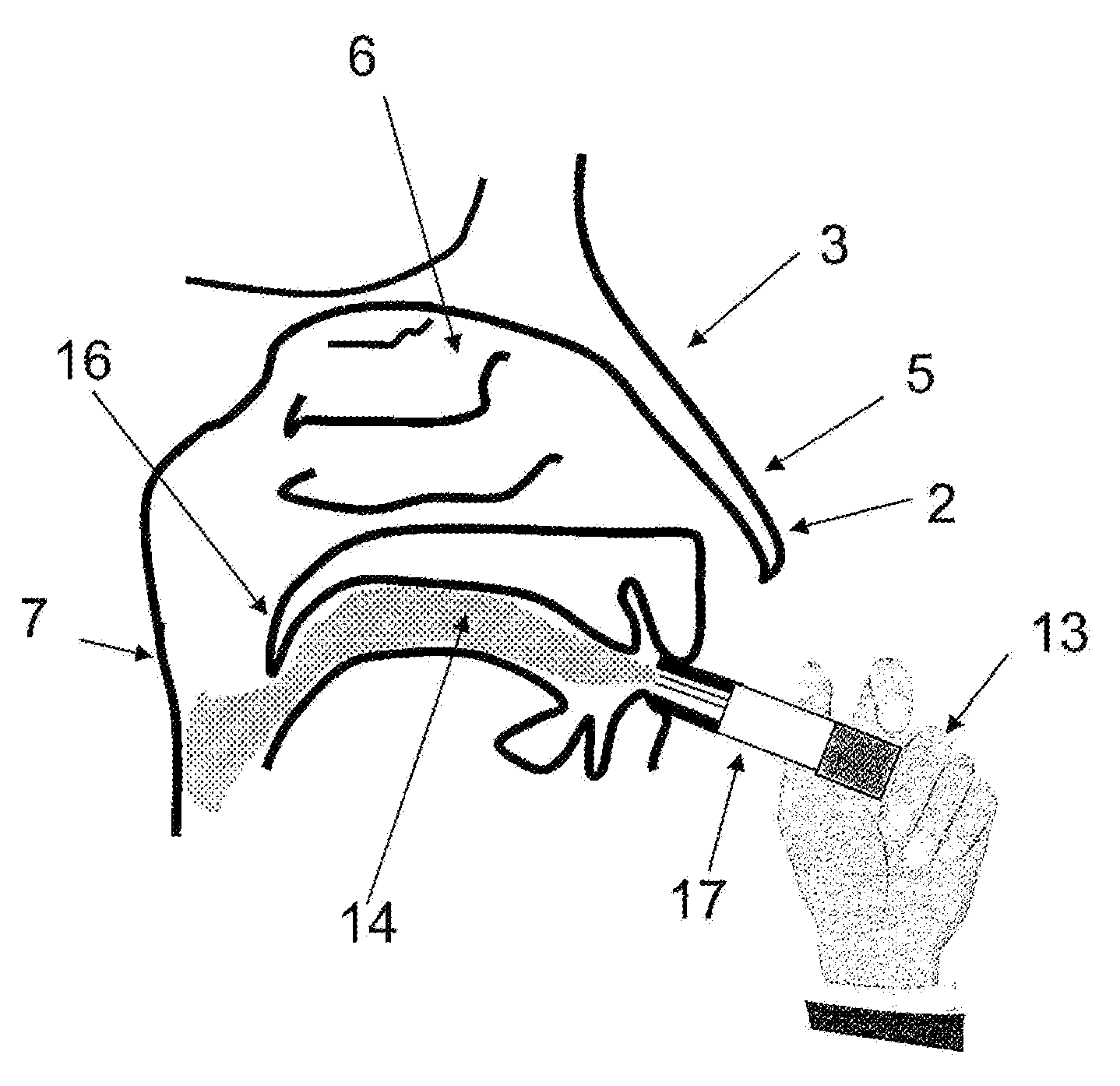 Device for oral administration of an aerosol for the rhinopharynx, the nasal cavities or the paranasal sinuses