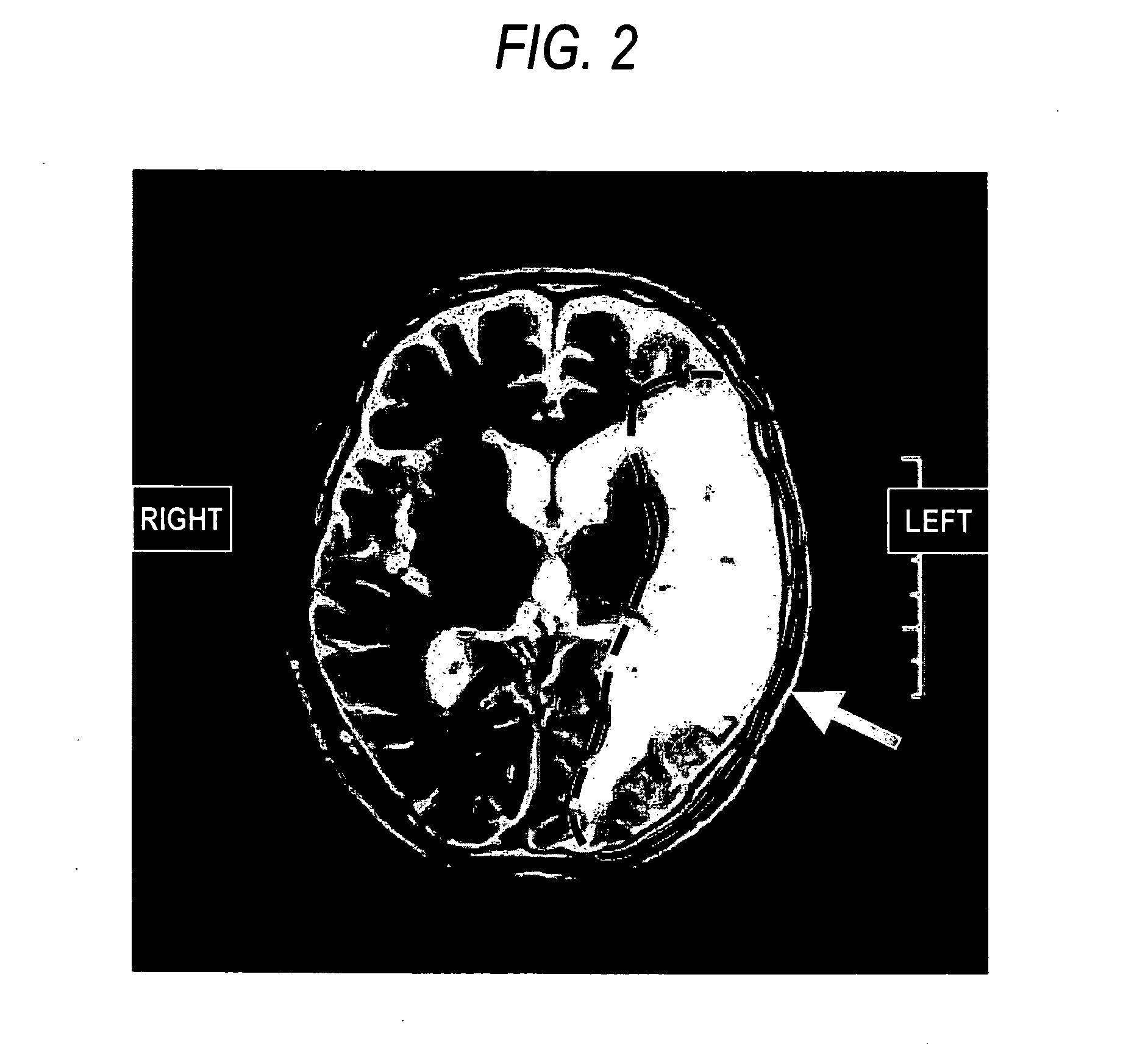 Agent or method for treating severe aphasia in cerebrovascular accident chronic stage