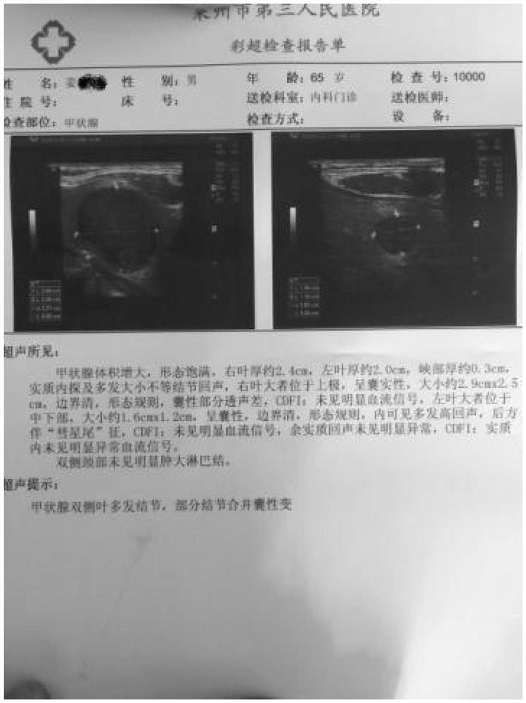 Traditional Chinese medicine formula for treating hashimoto disease