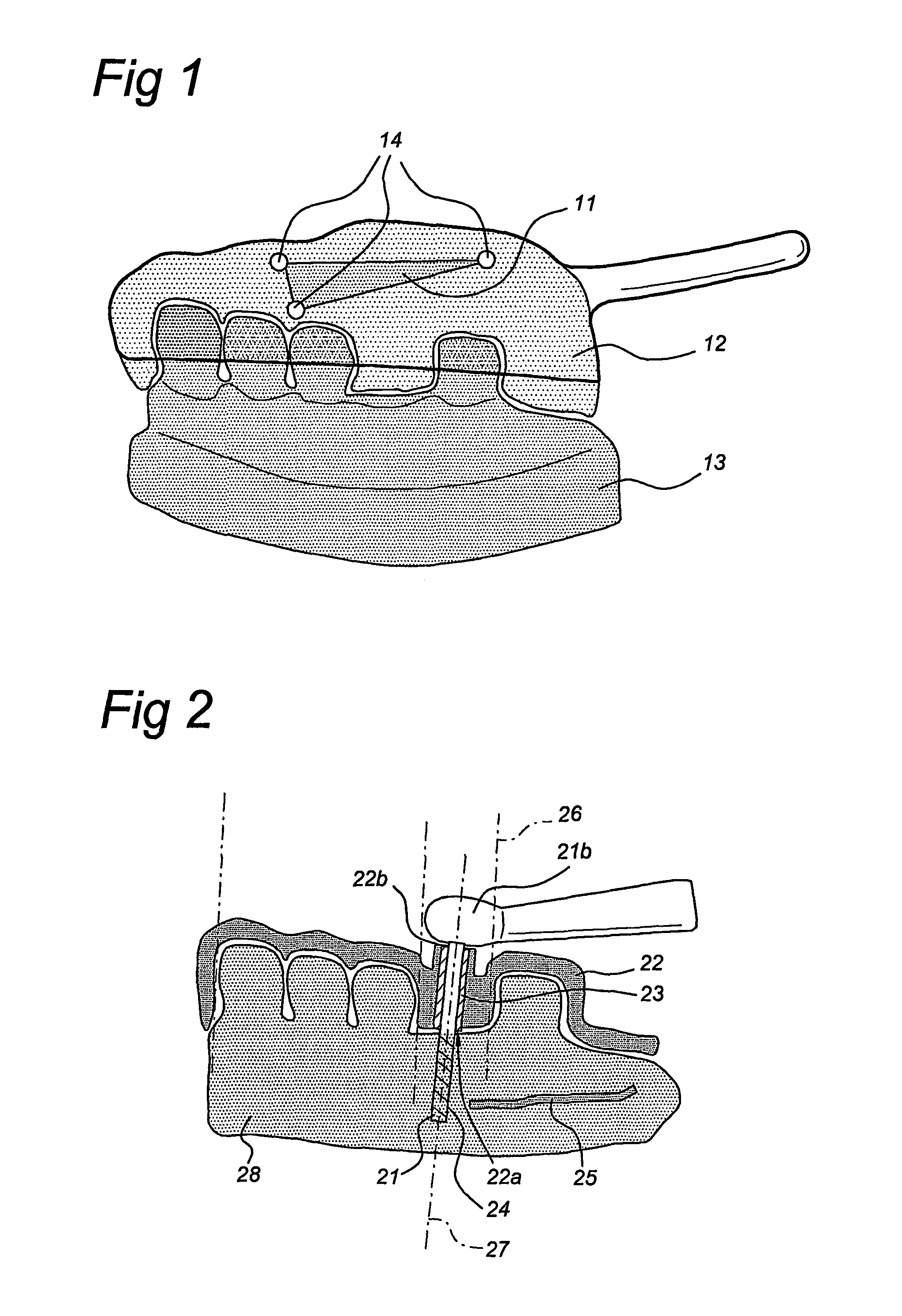 Method of manufacturing and installing a ceramic dental implant with an aesthetic implant abutment