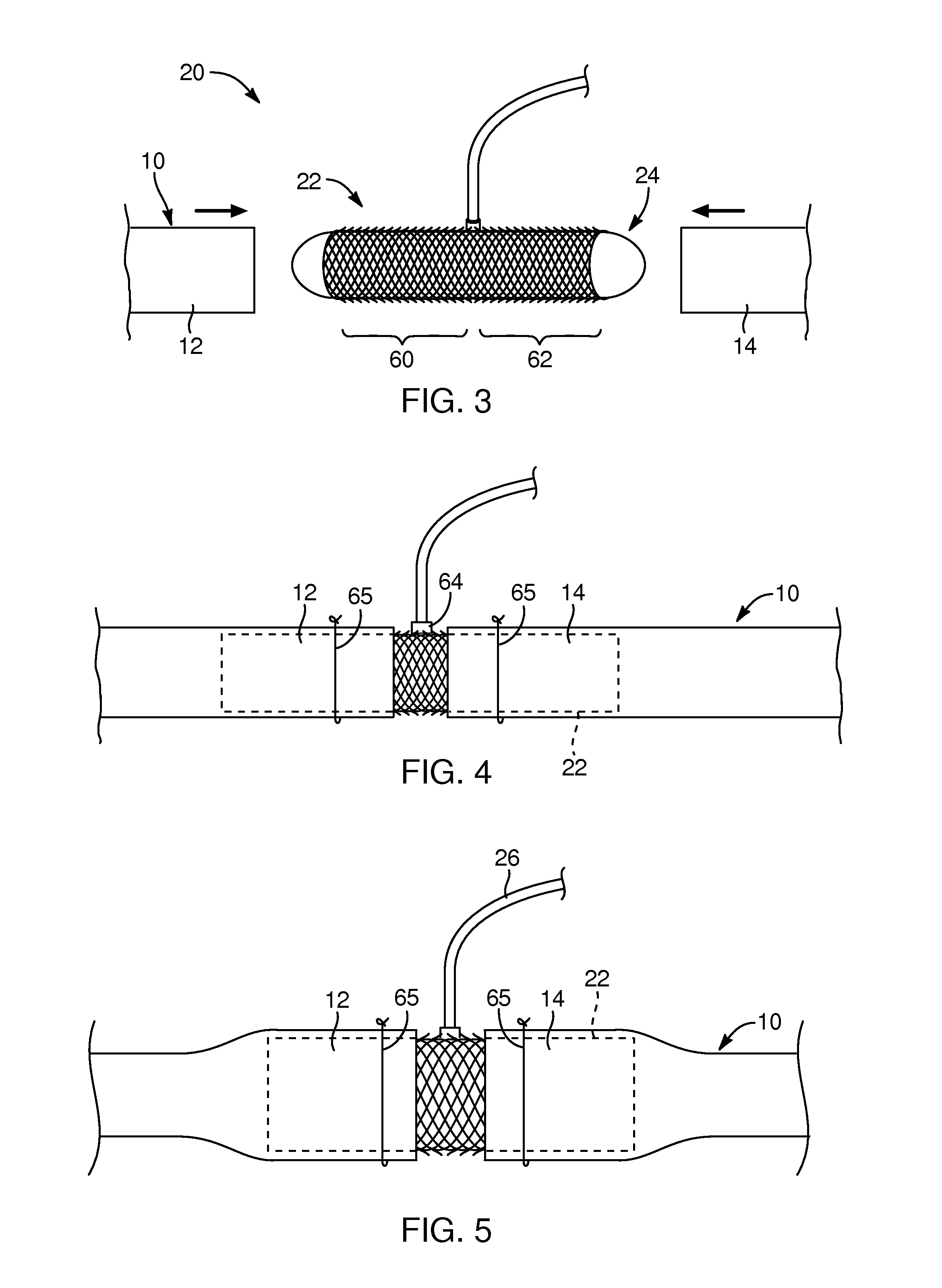 Open surgery anastomosis device, system, and method
