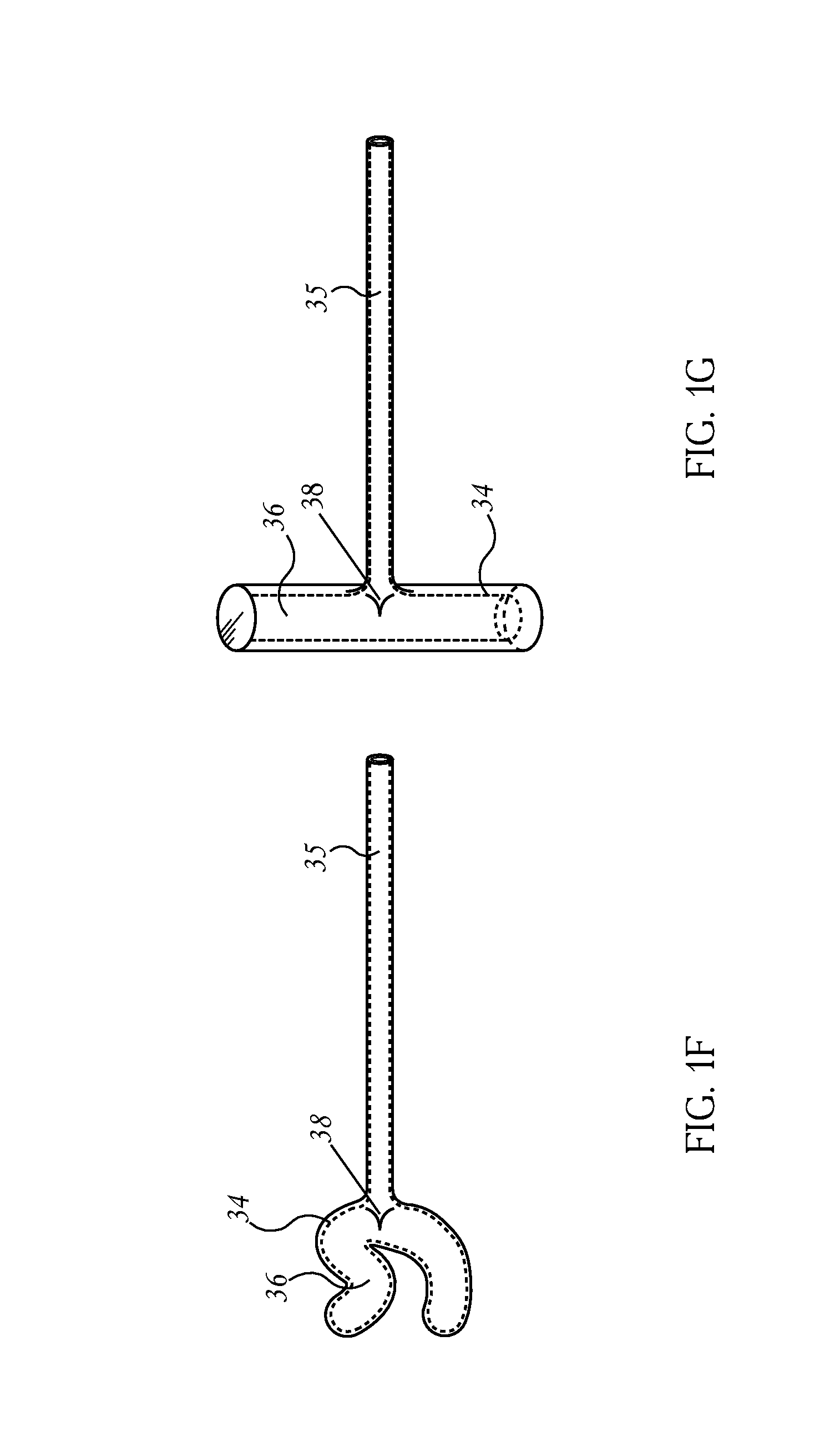 Methods and Devices For to Treatment of Obesity