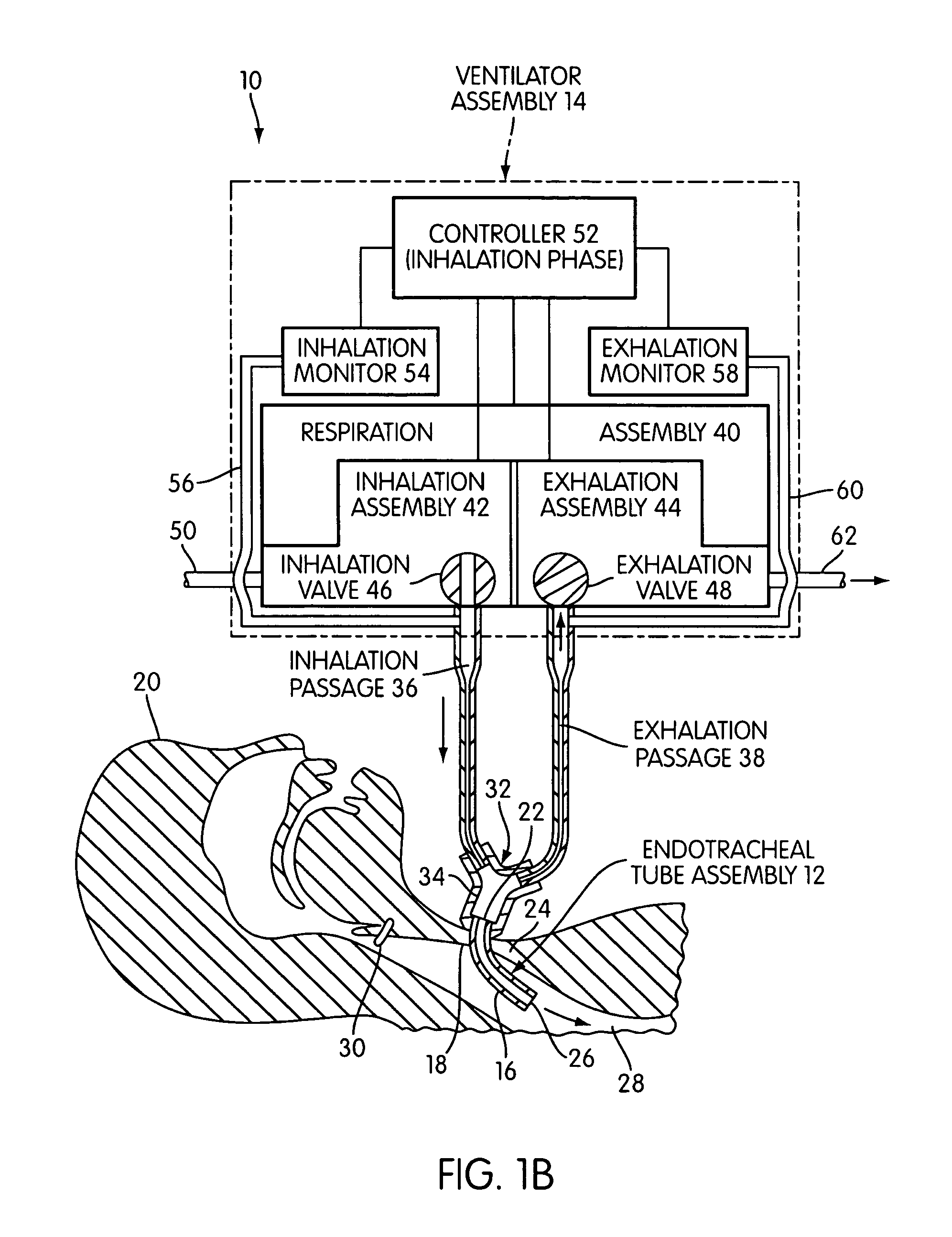 Ventilating apparatus and method enabling a patient to talk with or without a trachostomy tube check valve