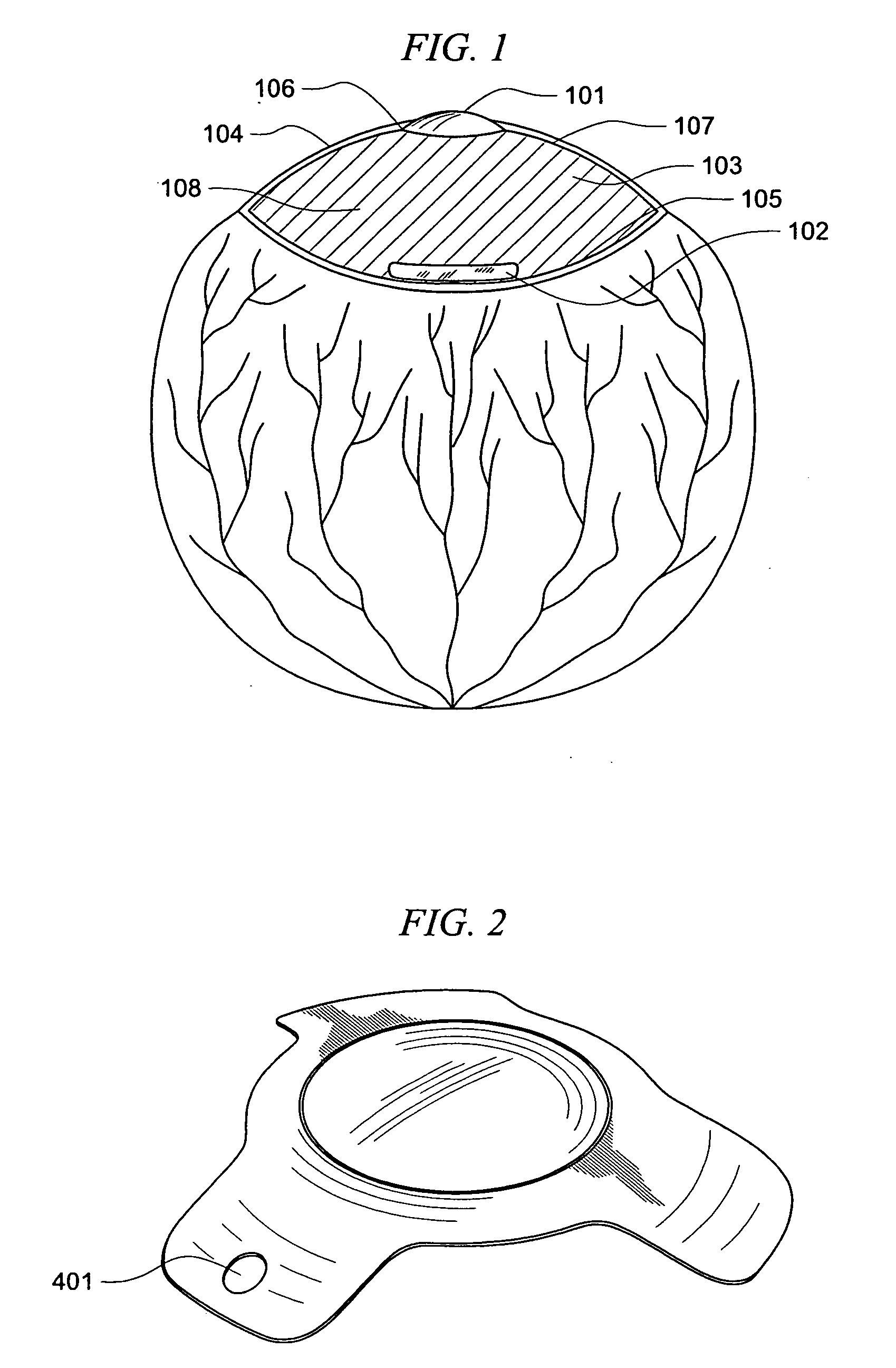 Multilens intraocular lens system with injectabe accommodation material