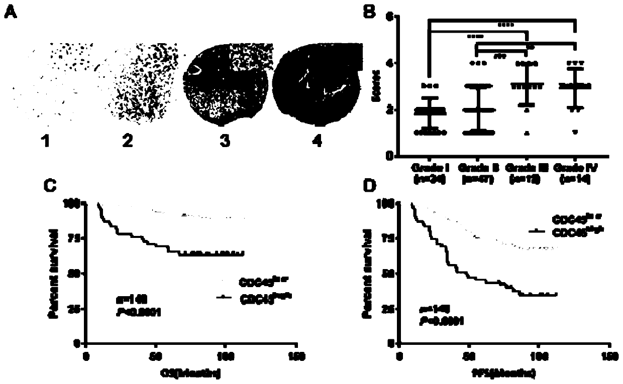 CDC45 as marker of glioblastoma multiforme and application of CDC45 as therapeutic target