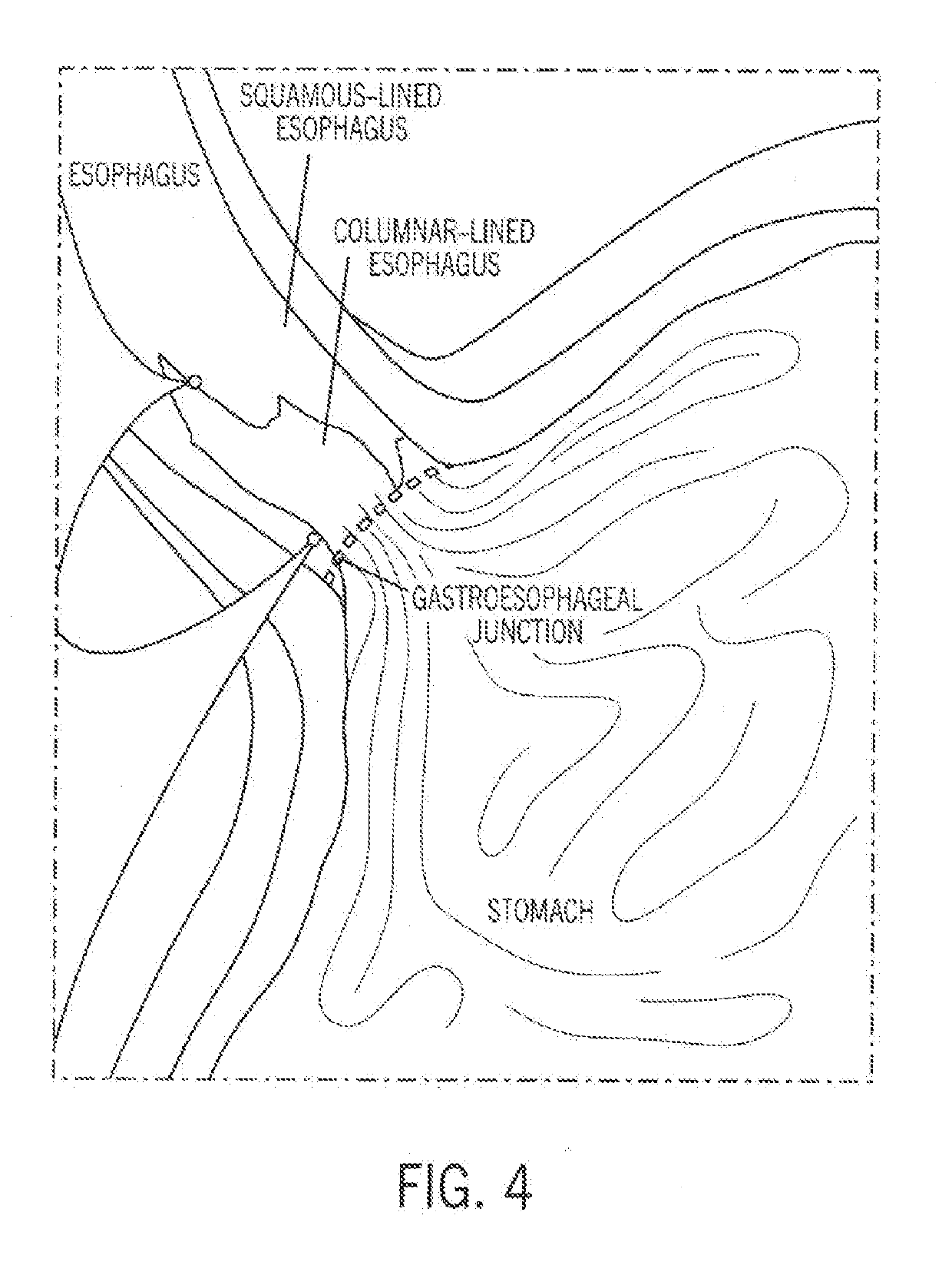 Esophageal ablation technology