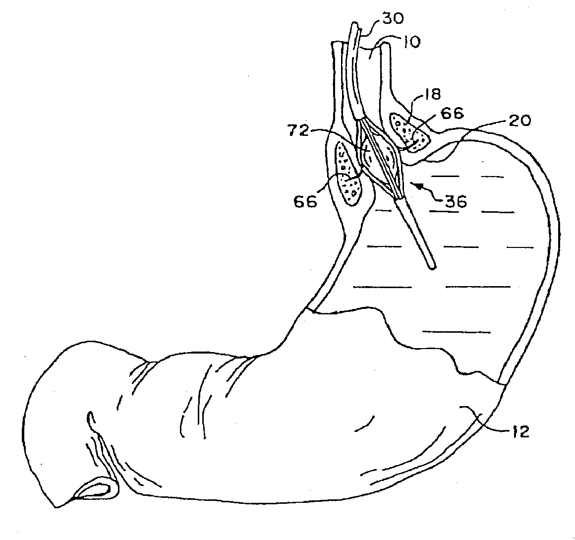 Method for Vacuum-Assisted Tissue Ablation
