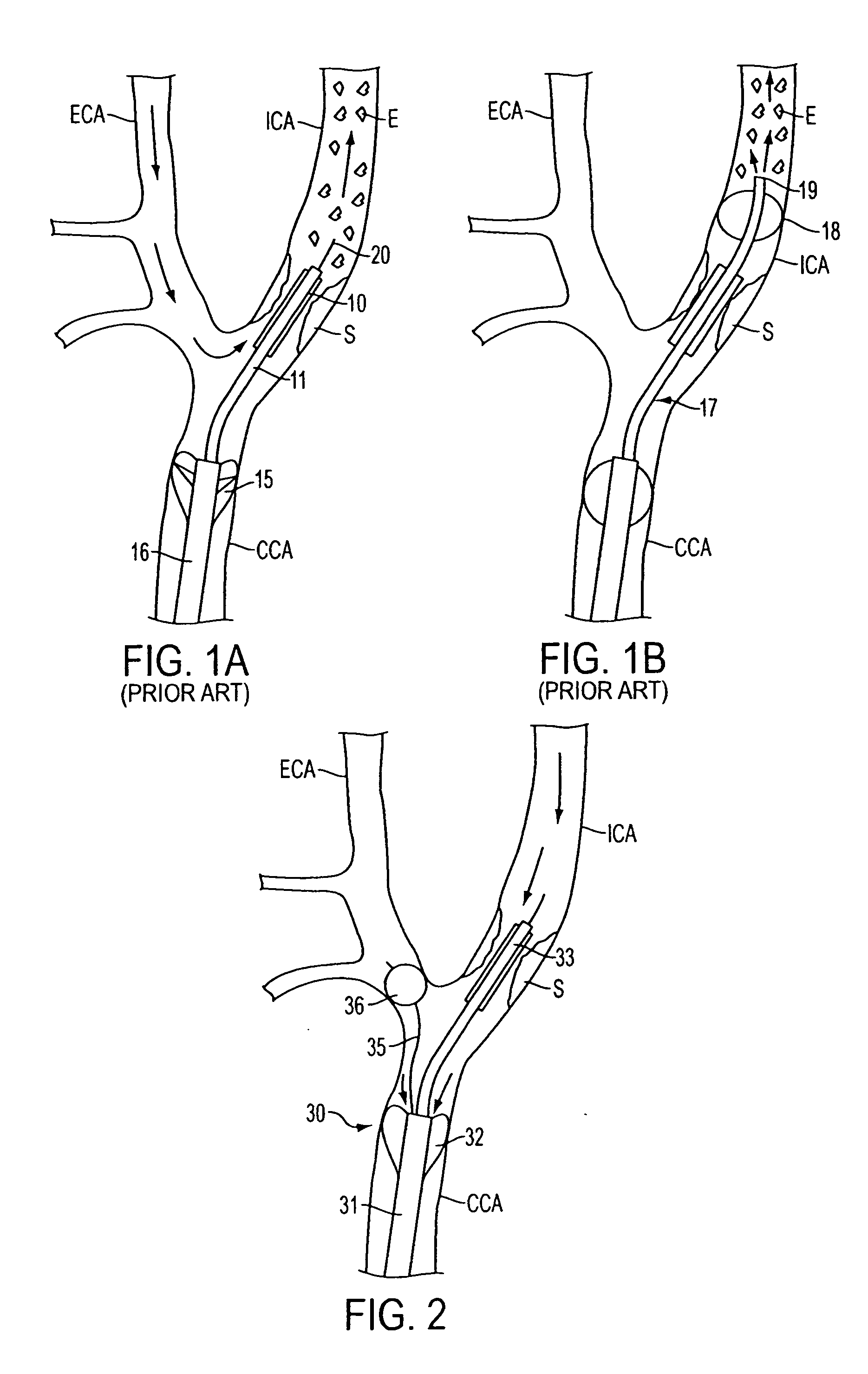 Apparatus and methods for reducing embolization during treatment of carotid artery disease