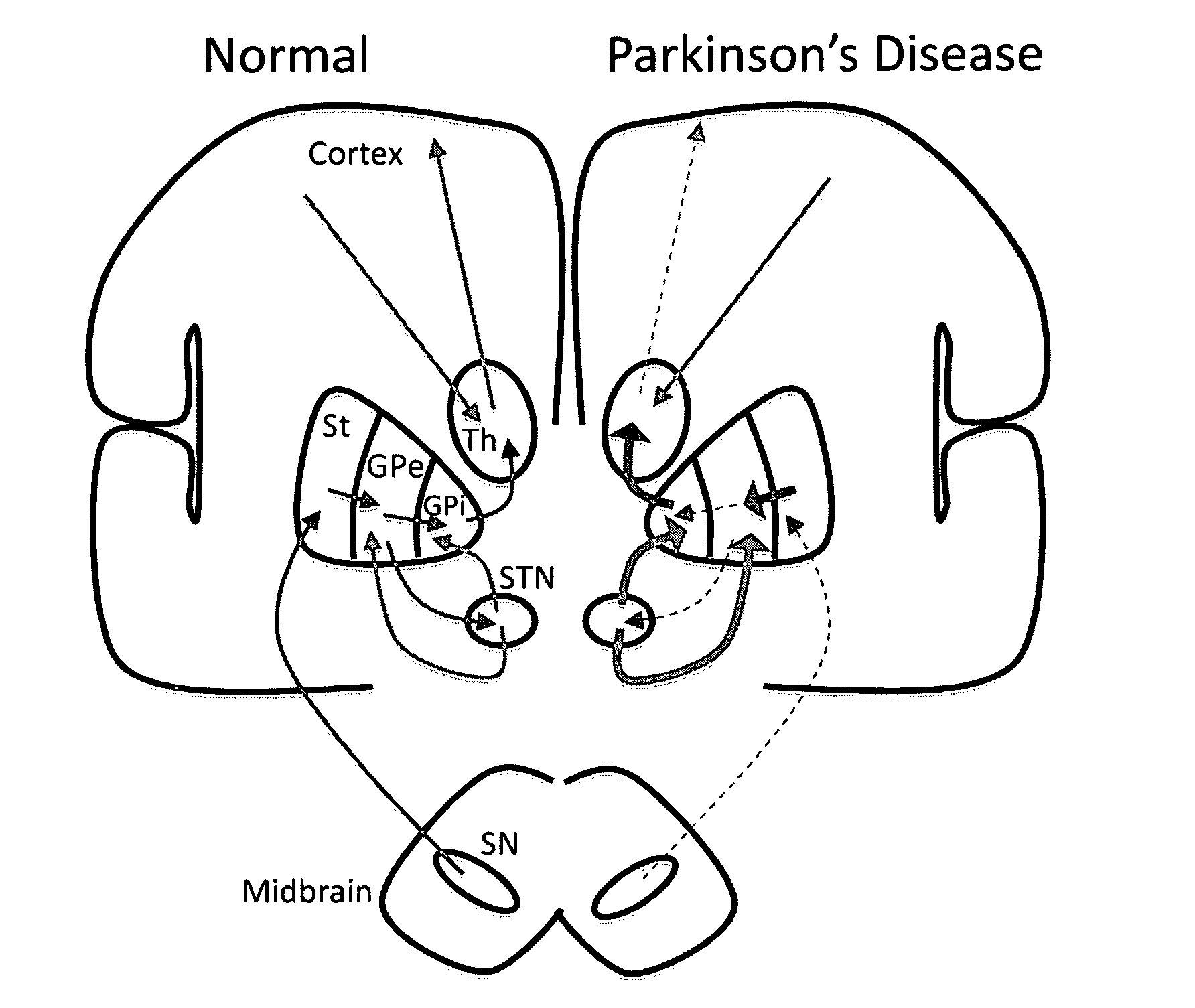 Model based control of Parkinson's disease